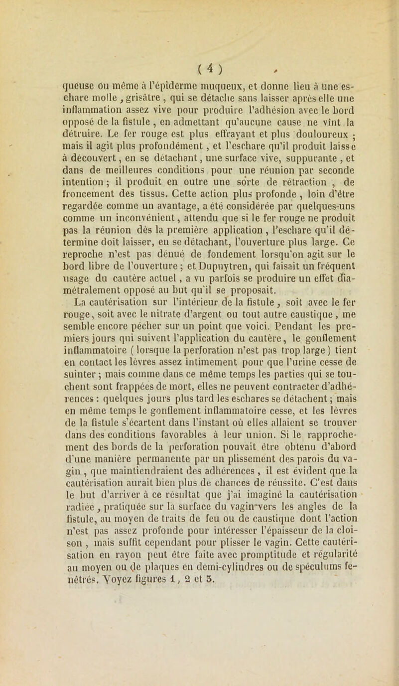 queusc ou même à l’épiderme muqueux, et donne lieu à une es- chare molle , grisâtre , qui se détache sans laisser après elle une inflammation assez vive pour produire l’adhésion avec le bord opposé de la fistule , en admettant qu’aucune cause ne vînt la détruire. Le fer rouge est plus effrayant et plus douloureux ; mais il agit plus profondément, et l’eschare qu’il produit laisse à découvert, en se détachant, une surface vive, suppurante , et dans de meilleures conditions pour une réunion par seconde intention ; il produit en outre une sorte de rétraction , de froncement des tissus. Cette action plus profonde , loin d’être regardée comme un avantage, acté considérée par quelques-uns comme un inconvénient, attendu que si le fer rouge ne produit pas la réunion dès la première application , l’eschare qu’il dé- termine doit laisser, en se détachant, l’ouverture plus large. Ce reproche n’est pas dénué de fondement lorsqu’on agit sur le bord libre de l’ouverture; etDupnytren, qui faisait un fréquent usage du cautère actuel, a vu parfois se produire un effet dia- métralement opposé au but qu'il se proposait. La cautérisation sur l’intérieur de la fistule , soit avec le fer rouge, soit avec le nitrate d’argent ou tout autre caustique , me semble encore pécher sur un point que voici. Pendant les pre- miers jours qui suivent l’application du cautère, le gonflement inflammatoire (lorsque la perforation n’est pas trop large) tient en contact les lèvres assez intimement pour que l’urine cesse de suinter ; mais comme dans ce même temps les parties qui se tou- chent sont frappées de mort, elles ne peuvent contracter d’adhé- rences : quelques jours plus tard les eschares se détachent ; mais en même temps le gonflement inflammatoire cesse, et les lèvres de la fistule s’écartent dans l'instant où elles allaient se trouver dans des conditions favorables à leur union. Si le rapproche- ment des bords de la perforation pouvait être obtenu d’abord d’une manière permanente par un plissement des parois du va- gin , que maintiendraient des adhérences , il est évident que la cautérisation aurait bien plus de chances de réussite. C’est dans le but d’arriver à ce résultat que j’ai imaginé la cautérisation radiée , pratiquée sur la surface du vagiirvers les angles de la fistule, au moyen de traits de feu ou de caustique dont l’action n’est pas assez profonde pour intéresser l’épaisseur de la cloi- son , mais suffit cependant pour plisser le vagin. Cette cautéri- sation en rayon peut être faite avec promptitude et régularité au moyen ou (,1e plaques en demi-cylindres ou de spéculums fe- nêtres. Yoycz figures 1, 2 et 5.