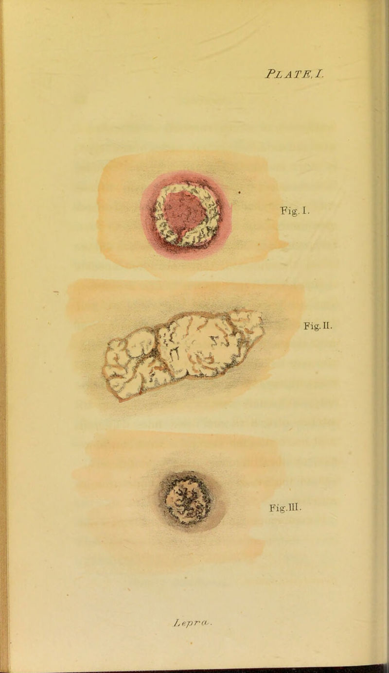 Plate, I. Mi Lepra,.