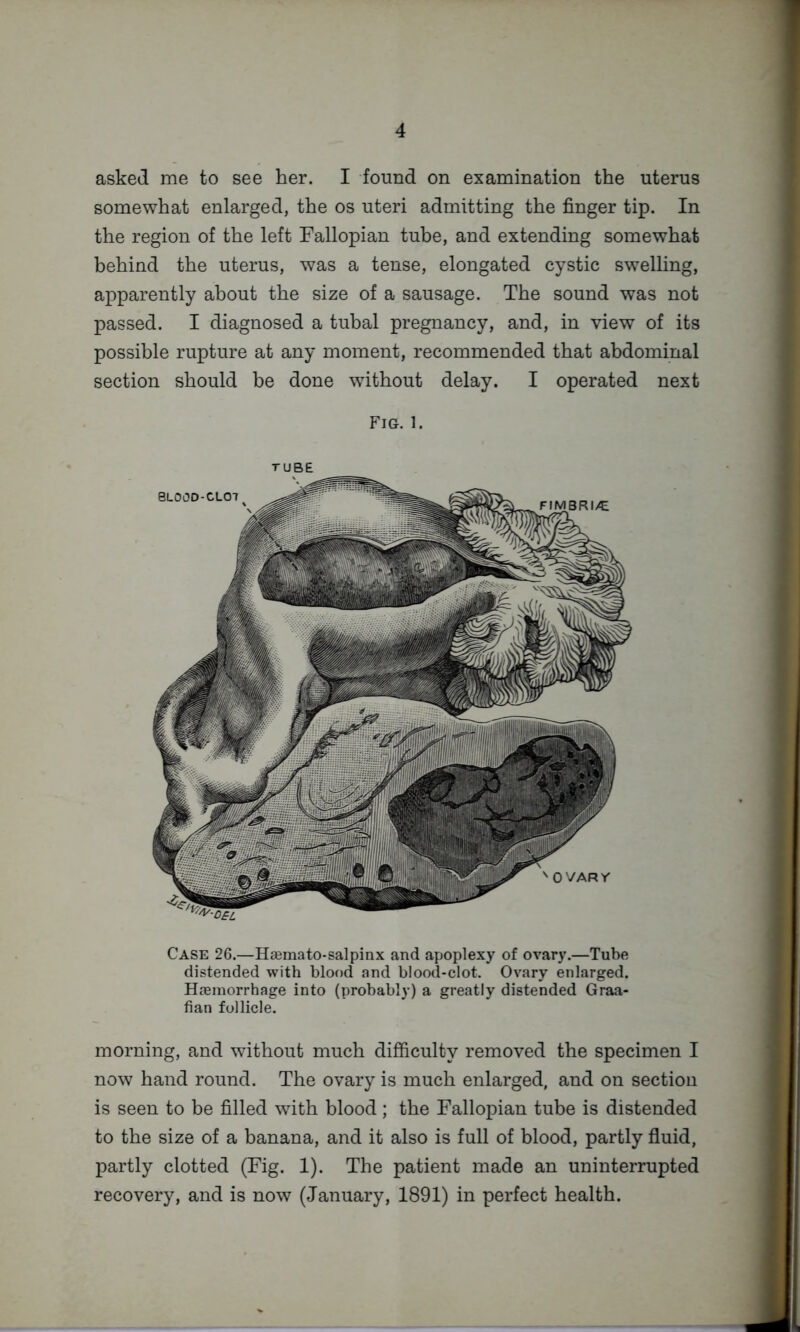 asked me to see her. I found on examination the uterus somewhat enlarged, the os uteri admitting the finger tip. In the region of the left Fallopian tube, and extending somewhat behind the uterus, was a tense, elongated cystic swelling, apparently about the size of a sausage. The sound was not passed. I diagnosed a tubal pregnancy, and, in view of its possible rupture at any moment, recommended that abdominal section should be done without delay. I operated next Fig. 1. TUBE Case 26.—Hgemato-salpinx and apoplexy of ovary.—Tube distended with blood and blood-clot. Ovary enlarged. Hfeinorrhage into (probably) a greatly distended Graa- fian follicle. morning, and without much difficulty removed the specimen I now hand round. The ovary is much enlarged, and on section is seen to be filled with blood; the Fallopian tube is distended to the size of a banana, and it also is full of blood, partly fluid, partly clotted (Fig. 1). The patient made an uninterrupted recovery, and is now (January, 1891) in perfect health.