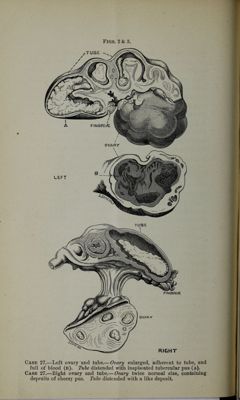 1 Figs. 2 & 3. Case 27.—Left ovary and tube.— Ovary enlarged, adherent to tube, and full of blood (b). Tube distended with inspissated tubercular pus (a). Case 27.—Right ovary and tube.— Ovary twice normal size, containing deposits of cheesy pus. Tulc distended with a like deposit.