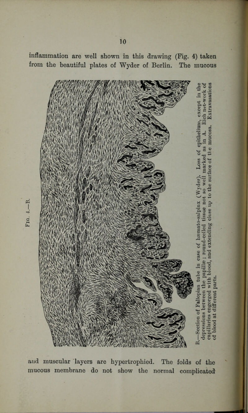 Fiq. inflammation are well shown in this drawing (Fig. 4) taken from the beautiful plates of Wyder of Berlin. The mucous and muscular 'layers are hypertrophied. The folds of the mucous membrane do not show the normal complicated B.—Section of Falloj)ian tube in case of lia3n)ato-salpinx (Wyder). Lops of epithelium, except in the depressions between the papillee ; round-celled tissue not so well marked as in A. Kich net-work of cai)illfiries engorged with blood, and extending close up to the surface of the mucosa. Extravasations of blood at different parts.