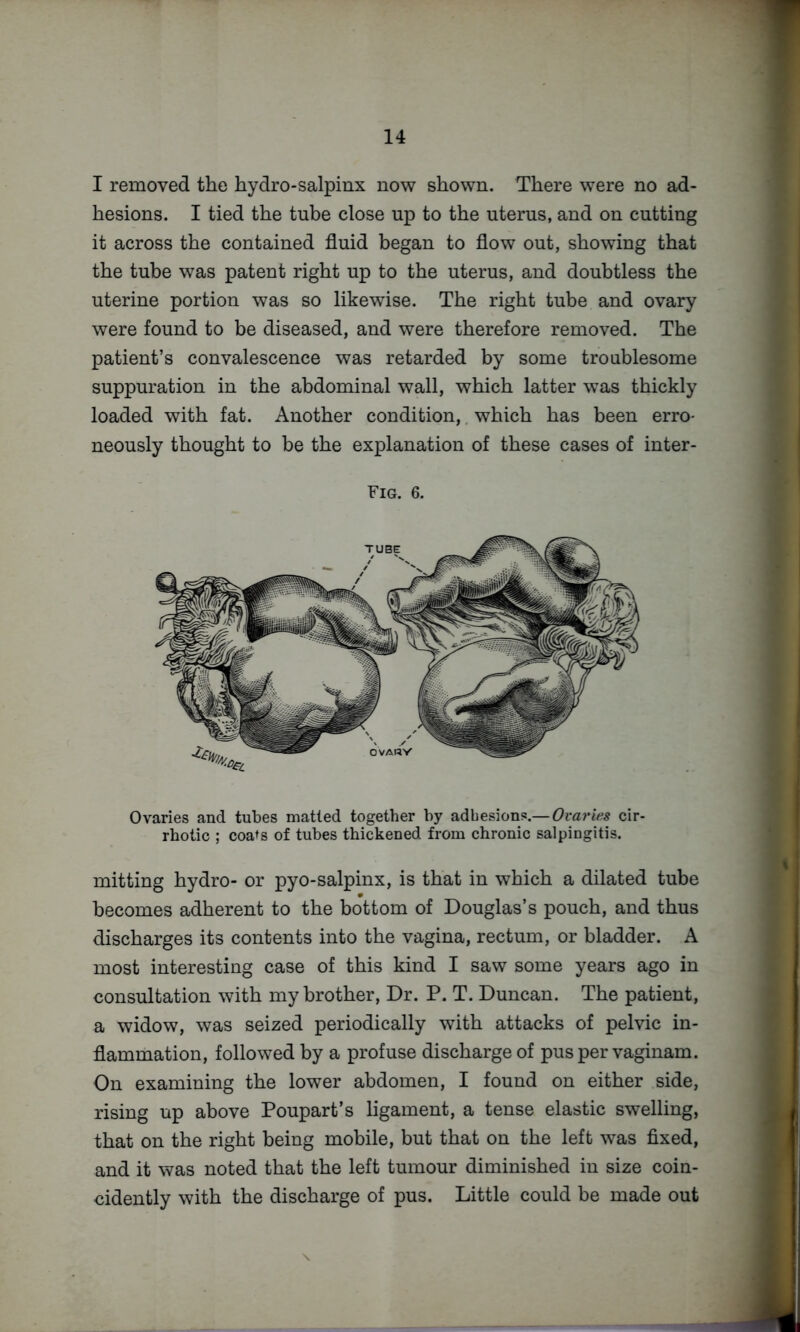 I removed the hydro-salpinx now shown. There were no ad- hesions. I tied the tube close up to the uterus, and on cutting it across the contained fluid began to flow out, showing that the tube was patent right up to the uterus, and doubtless the uterine portion was so likewise. The right tube and ovary were found to be diseased, and were therefore removed. The patient’s convalescence was retarded by some troublesome suppuration in the abdominal wall, which latter was thickly loaded with fat. Another condition,, which has been erro- neously thought to be the explanation of these cases of inter- Fig. 6. Ovaries and tubes matted together by adhesions.— Ovaries cir- rhotic ; coats of tubes thickened from chronic salpingitis. mitting hydro- or pyo-salpinx, is that in which a dilated tube becomes adherent to the bottom of Douglas’s pouch, and thus discharges its contents into the vagina, rectum, or bladder. A most interesting case of this kind I saw some years ago in consultation with my brother. Dr. P. T. Duncan. The patient, a widow, was seized periodically with attacks of pelvic in- flammation, followed by a profuse discharge of pusper vaginam. On examining the lower abdomen, I found on either side, rising up above Poupart’s ligament, a tense elastic swelling, that on the right being mobile, but that on the left was fixed, and it was noted that the left tumour diminished in size coin- cidently with the discharge of pus. Little could be made out \