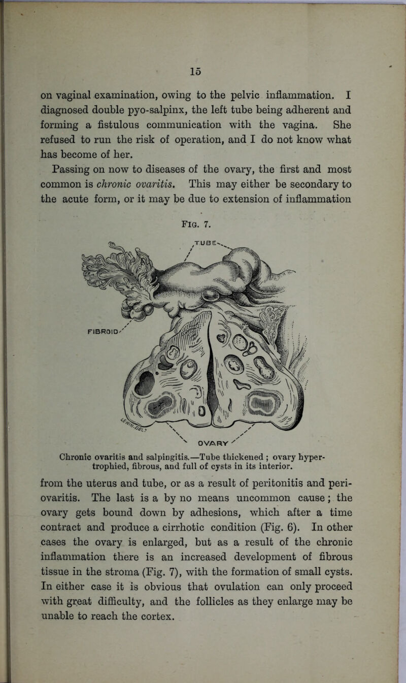 on vaginal examination, owing to the pelvic inflammation. I diagnosed double pyo-salpinx, the left tube being adherent and forming a fistulous communication with the vagina. She refused to run the risk of operation, and I do not know what has become of her. Passing on now to diseases of the ovary, the first and most common is chronic ovaritis. This may either be secondary to the acute form, or it may be due to extension of inflammation Fig. 7. Chronic ovaritis and salpingitis.—Tube thickened ; ovary hyper- trophied, fibrous, and full of cysts in its interior. from the uterus and tube, or as a result of peritonitis and peri- ovaritis. The last is a by no means uncommon cause; the ovary gets bound down by adhesions, which after a time contract and produce a cirrhotic condition (Fig. 6). In other cases the ovary is enlarged, but as a result of the chronic inflammation there is an increased development of fibrous tissue in the stroma (Fig. 7), with the formation of small cysts. In either case it is obvious that ovulation can only proceed with great difficulty, and the follicles as they enlarge may be unable to reach the cortex.