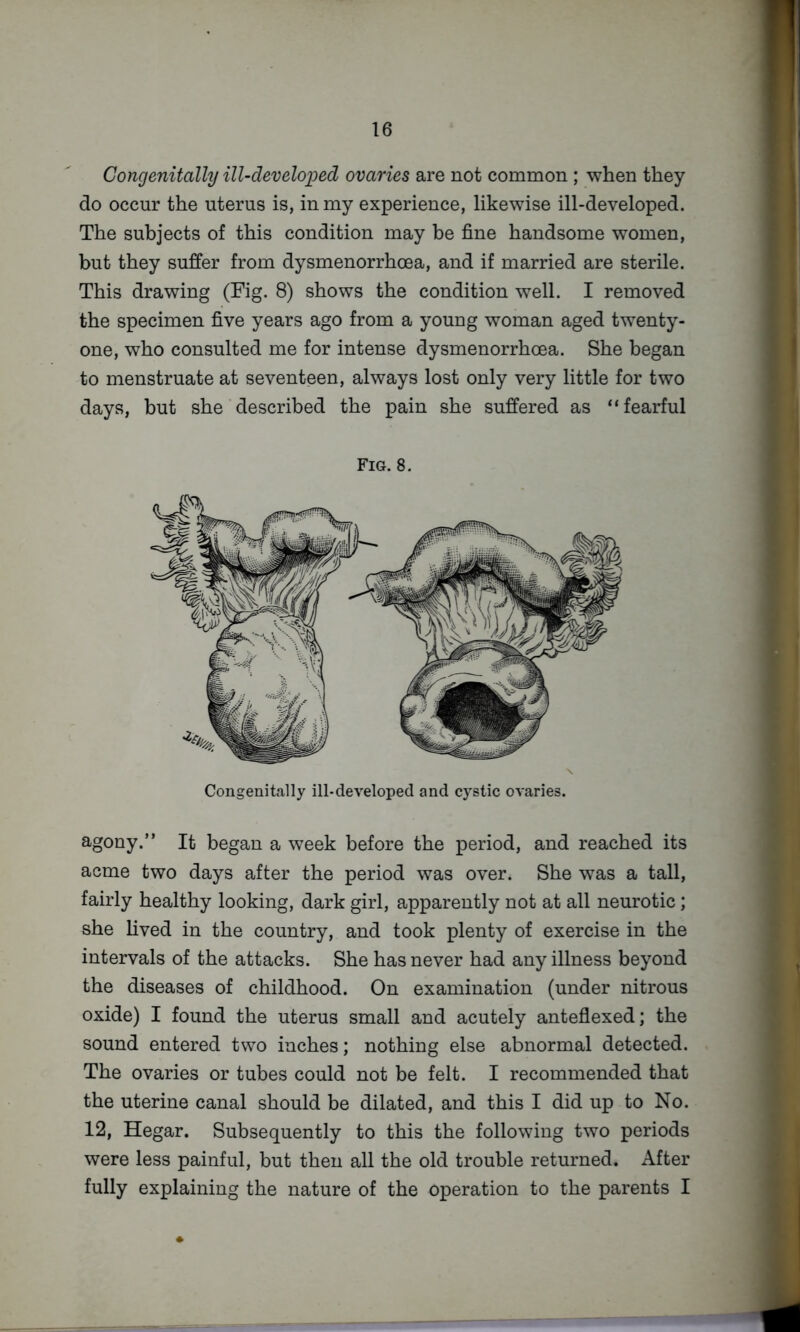 Congenitally ill~develoi^ed ovaries are not common ; when they do occur the uterus is, in my experience, likewise ill-developed. The subjects of this condition may be fine handsome women, but they suffer from dysmenorrhoea, and if married are sterile. This drawing (Fig. 8) shows the condition well. I removed the specimen five years ago from a young woman aged twenty- one, who consulted me for intense dysmenorrhoea. She began to menstruate at seventeen, always lost only very little for two days, but she described the pain she suffered as “fearful Fig. 8. Congenitally ill-developed and cystic ovaries. agony.” It began a week before the period, and reached its acme two days after the period was over. She was a tall, fairly healthy looking, dark girl, apparently not at all neurotic; she hved in the country, and took plenty of exercise in the intervals of the attacks. She has never had any illness beyond the diseases of childhood. On examination (under nitrous oxide) I found the uterus small and acutely anteflexed; the sound entered two inches; nothing else abnormal detected. The ovaries or tubes could not be felt. I recommended that the uterine canal should be dilated, and this I did up to No. 12, Hegar. Subsequently to this the following two periods were less painful, but then all the old trouble returned. After fully explaining the nature of the operation to the parents I