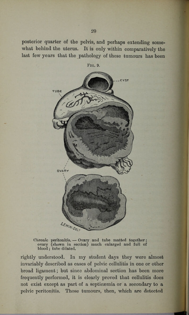 posterior quarter of the pelvis, and perhaps extending some- what behind the uterus. It is only within comparatively the last few years that the pathology of these tumours has been Fig. 9. Chronic peritonitis. — Ovary and tube matted together; ovary (shown in section) much enlarged and full of blood; tube dilated. rightly understood. In my student days they were almost invariably described as cases of pelvic cellulitis in one or other broad ligament; but since abdominal section has been more frequently performed, it is clearly proved that cellulitis does not exist except as part of a septicaemia or a secondary to a pelvic peritonitis. Those tumours, then, which are detected