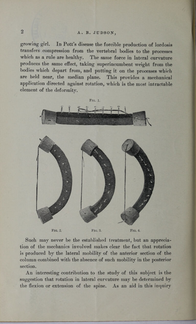growing girl. In Pott’s disease the forcible production of lordosis transfers compression from the vertebral bodies to the processes which as a rule are healthy. The same force in lateral curvature produces the same effect, taking superincumbent weight from the bodies which depart from, and putting it on the processes which are held near, the median plane. This provides a mechanical application directed against rotation, which is the most intractable element of the deformity. Fig. l. Fig. 2. Fig. 3. Fig. 4. Such may never be the established treatment, but an apprecia- tion of the mechanics involved makes clear the fact that rotation is produced by the lateral mobility of the anterior section of the column combined with the absence of such mobility in the posterior section. An interesting contribution to the study of this subject is the suggestion that rotation in lateral curvature may be determined by the flexion or extension of the spine. As an aid in this inquiry