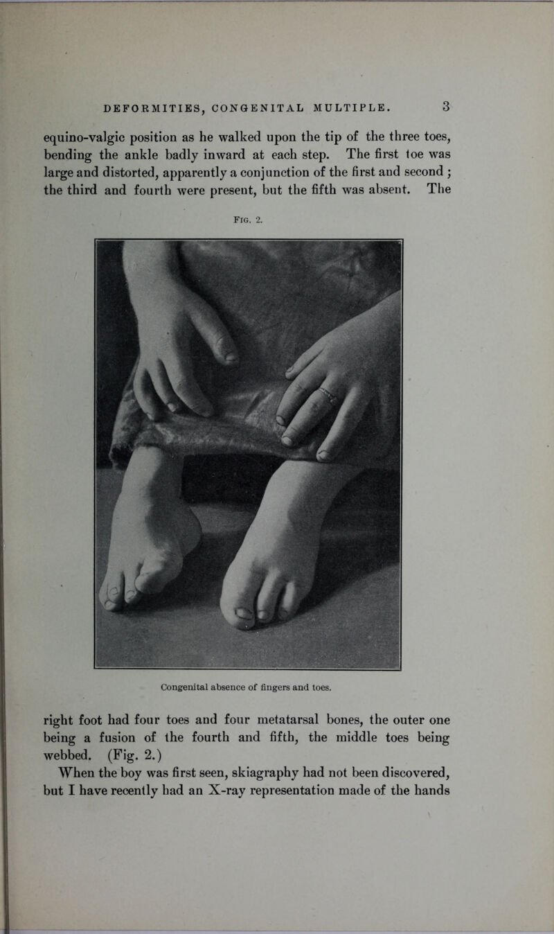 equino-valgic position as he walked upon the tip of the three toes, bending the ankle badly inward at each step. The first toe was large and distorted, apparently a conjunction of the first and second ; the third and fourth were present, but the fifth was absent. The Fig. 2. Congenital absence of fingers and toes. right foot had four toes and four metatarsal bones, the outer one being a fusion of the fourth and fifth, the middle toes being webbed. (Fig. 2.) When the boy was first seen, skiagraphy had not been discovered, but I have recently had an X-ray representation made of the hands