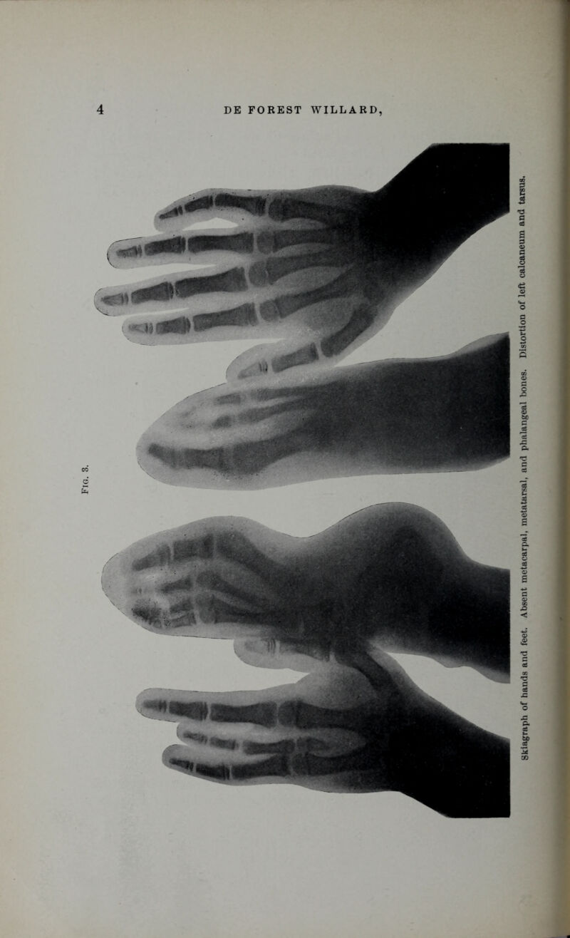 Fig. 1 Skiagraph of hands and feet. Absent metacarpal, metatarsal, and phalangeal bones. Distortion of left calcaneum and tarsus.