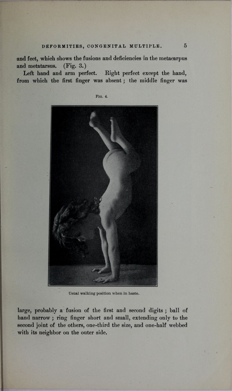 and feet, which shows the fusions and deficiencies in the metacarpus and metatarsus. (Fig. 3.) Left hand and arm perfect. Right perfect except the hand, from which the first finger was absent; the middle finger was Fig. 4. Usual walking position when in haste. large, probably a fusion of the first and second digits ; ball of hand narrow ; ring finger short and small, extending only to the second joint of the others, one-third the size, and one-half webbed with its neighbor on the outer side.