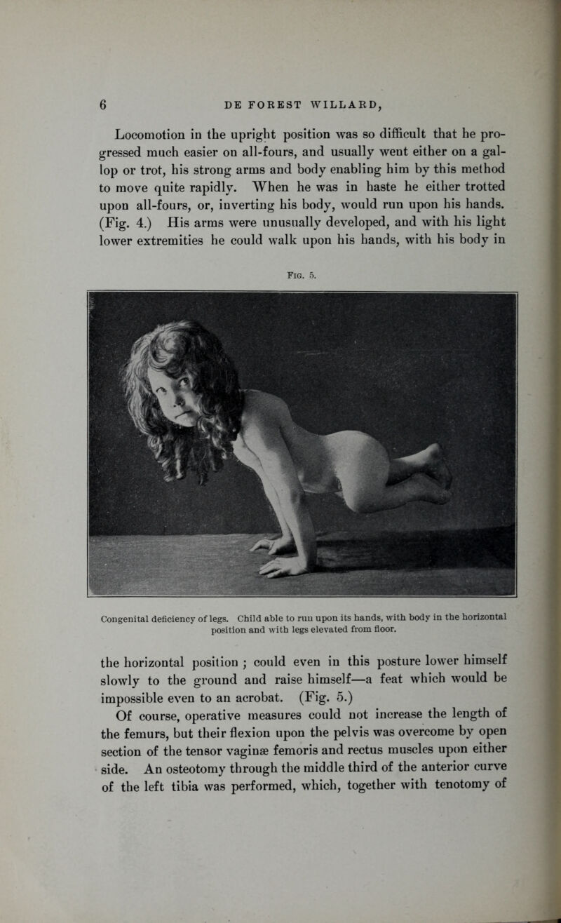 Locomotion in the upright position was so difficult that he pro- gressed much easier on all-fours, and usually went either on a gal- lop or trot, his strong arms and body enabling him by this method to move quite rapidly. When he was in haste he either trotted upon all-fours, or, inverting his body, would run upon his hands. (Fig. 4.) His arms were unusually developed, and with his light lower extremities he could walk upon his hands, with his body in Fig. 5. Congenital deficiency of legs. Child able to run upon its hands, with body in the horizontal position and with legs elevated from floor. the horizontal position ; could even in this posture lower himself slowly to the ground and raise himself—a feat which would be impossible even to an acrobat. (Fig. 5.) Of course, operative measures could not increase the length of the femurs, but their flexion upon the pelvis was overcome by open section of the tensor vaginae femoris and rectus muscles upon either side. An osteotomy through the middle third of the anterior curve of the left tibia was performed, which, together with tenotomy of