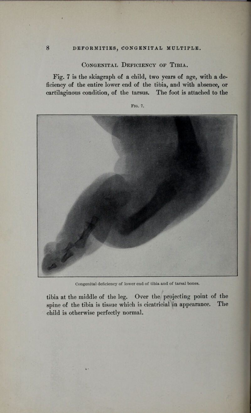 Congenital Deficiency of Tibia. Fig. 7 is the skiagraph of a child, two years of age, with a de- ficiency of the entire lower end of the tibia, and with absence, or cartilaginous condition, of the tarsus. The foot is attached to the Fig. 7. Congenital deficiency of lower end of tibia and of tarsal bones. tibia at the middle of the leg. Over the projecting point of the spine of the tibia is tissue which is cicatricial in appearance. The child is otherwise perfectly normal.