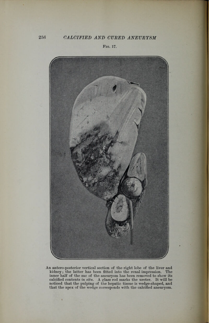 An antero-posterior vertical section of the right lobe of the liver and kidney; the latter has been fitted into the renal impression. The inner half of the sac of the aneurysm has been removed to show its calcified contents in situ. A glass rod marks the ureter. It will be noticed that the pulping of the hepatic tissue is wedge-shaped, and that the apex of the wedge corresponds with the calcified aneurysm.