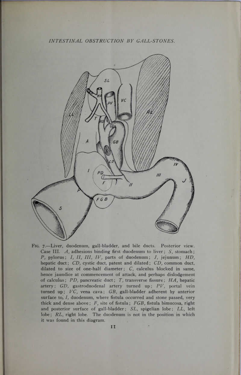 Fig. 7.—Liver, duodenum, gall-bladder, and bile ducts. Posterior view. Case III. A, adhesions binding first duodenum to liver; S, stomach; P, pylorus; I, II, III, IV, parts of duodenum; I, jejunum; HD, hepatic duct; CD, cystic duct, patent and dilated; CD, common duct, dilated to size of one-half diameter; C, calculus blocked in same, hence jaundice at commencement of attack, and perhaps dislodgement of calculus; PD, pancreatic duct; T, transverse fissure; HA, hepatic artery; GD, gastroduodenal artery turned up; PV, portal vein turned up; VC, vena cava; GB, gall-bladder adherent by anterior surface to, I, duodenum, where fistula occurred and stone passed, very thick and dense above; F, site of fistula; FGB, fistula bimucosa, right and posterior surface of gall-bladder; SL, spigelian lobe; LL, left lobe; RL, right lobe. The duodenum is not in the position in which it was found in this diagram.