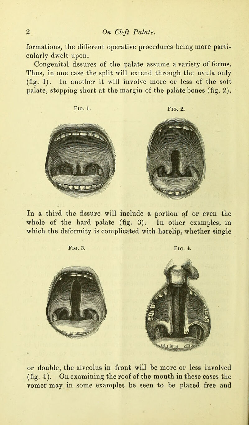 formations, the different operative procedures being more parti- cularly dwelt upon. Congenital fissures of the palate assume a variety of forms. Thus, in one case the split will extend through the uvula only (fig. 1). In another it will involve more or less of the soft palate, stopping short at the margin of the palate bones (fig. 2). Fig. 1. Fig. 2. In a third the fissure will include a portion of or even the whole of the hard palate (fig. 3). In other examples, in which the deformity is complicated with harelip, whether single Fig. 3. Fig. 4. or double, the alveolus in front will be more or less involved (fig. 4). On examining the roof of the mouth in these cases the vomer may in some examples be seen to be placed free and