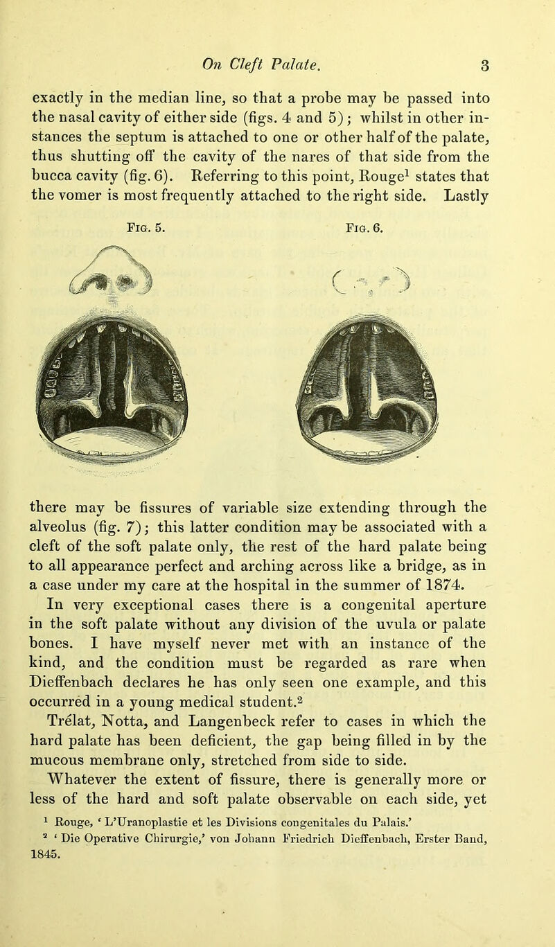 exactly in the median line, so that a prohe may be passed into the nasal cavity of either side (figs. 4 and 5) ; whilst in other in- stances the septum is attached to one or other half of the palate, thus shutting off the cavity of the nares of that side from the bucca cavity (fig. 6). Referring to this point, Rouge^ states that the vomer is most frequently attached to the right side. Lastly Fig. 5. Fig. 6. there may be fissures of variable size extending through the alveolus (fig. 7); this latter condition may be associated with a cleft of the soft palate only, the rest of the hard palate being to all appearance perfect and arching across like a bridge, as in a case under my care at the hospital in the summer of 1874. In very exceptional cases there is a congenital aperture in the soft palate without any division of the uvula or palate bones. I have myself never met with an instance of the kind, and the condition must be regarded as rare when Dieffenbach declares he has only seen one example, and this occurred in a young medical student.^ Trelat, Notta, and Langenbeck refer to cases in which the hard palate has been deficient, the gap being filled in by the mucous membrane only, stretched from side to side. Whatever the extent of fissure, there is generally more or less of the hard and soft palate observable on each side, yet 1 Rouge, ‘ L’Uranoplastie et les Divisions congenitales du Palais.’ ’ ‘ Die Operative Chirurgie,’ von Johann Friedrich Dieffenbach, Erster Band, 1845.