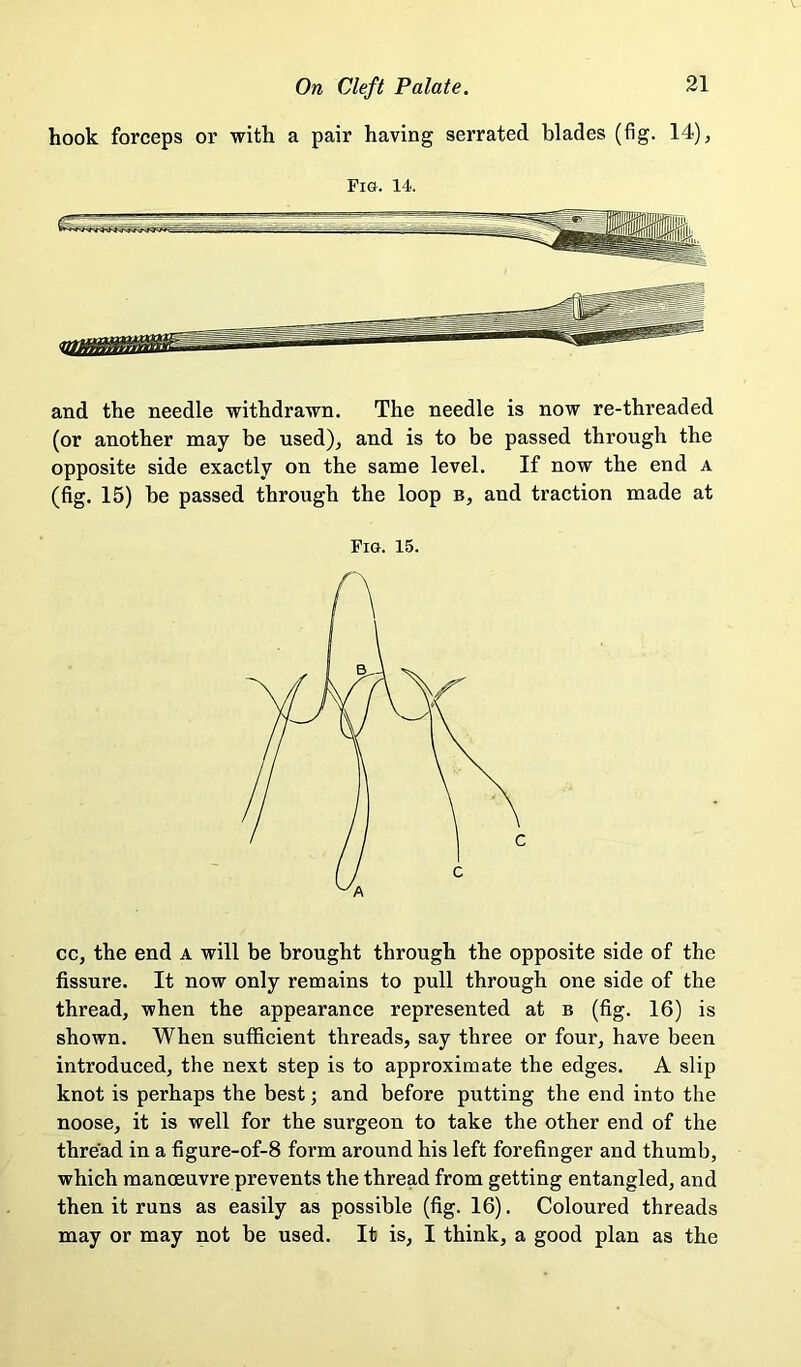 hook forceps or with a pair having serrated blades (fig. 14), Fig. 14. and the needle withdrawn. The needle is now re-threaded (or another may be used), and is to be passed through the opposite side exactly on the same level. If now the end a (fig. 15) be passed through the loop b, and traction made at Fig. 15. cc, the end a will be brought through the opposite side of the fissure. It now only remains to pull through one side of the thread, when the appearance represented at b (fig. 16) is shown. When sufficient threads, say three or four, have been introduced, the next step is to approximate the edges. A slip knot is perhaps the best; and before putting the end into the noose, it is well for the surgeon to take the other end of the thread in a figure-of-8 form around his left forefinger and thumb, whieh manoeuvre prevents the thread from getting entangled, and then it runs as easily as possible (fig. 16). Coloured threads may or may not be used. It is, I think, a good plan as the