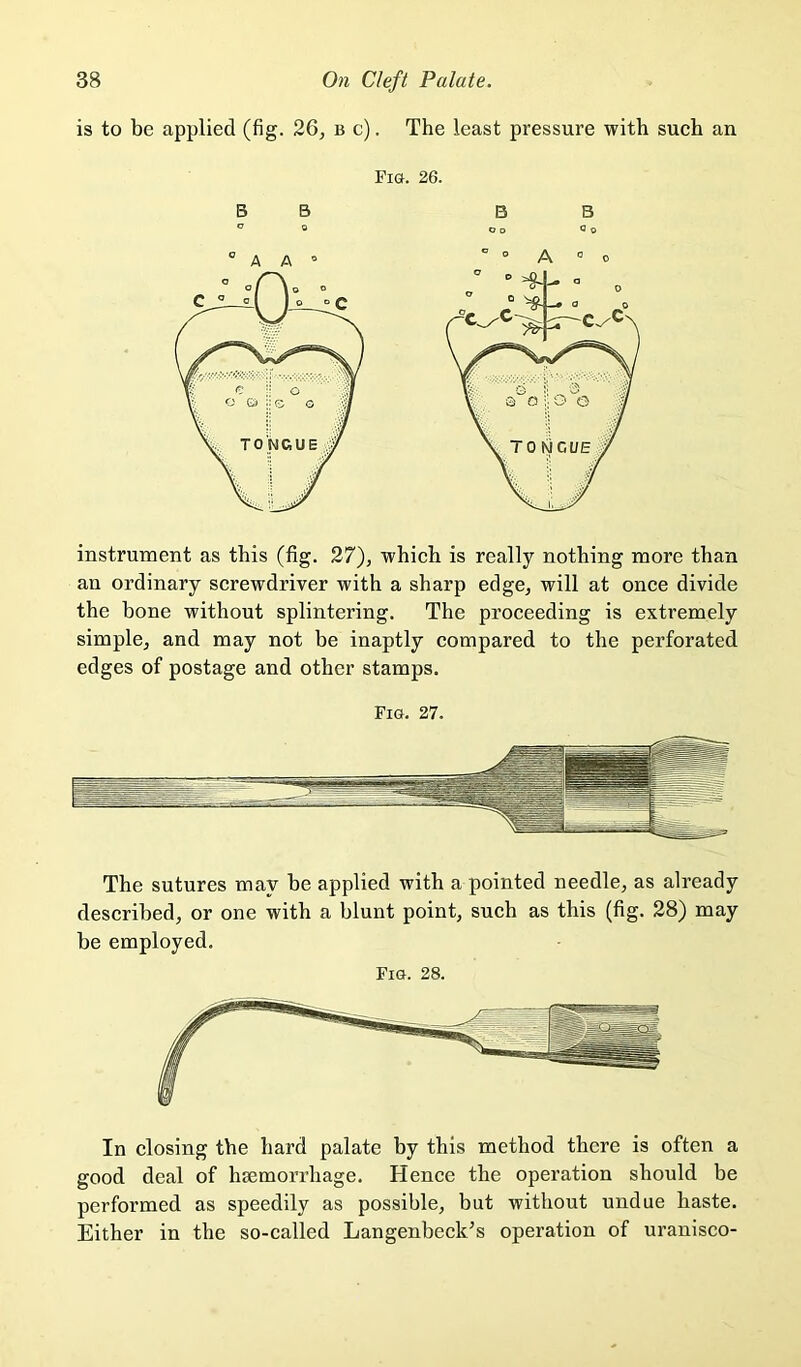 is to be applied (fig. 26, b c) . The least pressure with sueh an Fig. 26. instrument as this (fig. 27), whieh is really nothing more than an ordinary serewdriver with a sharp edge, will at once divide the bone without splintering. The proceeding is extremely simple, and may not be inaptly compared to the perforated edges of postage and other stamps. Fig. 27. The sutures may be applied with a pointed needle, as already described, or one with a blunt point, such as this (fig. 28) may be employed. Fig. 28. In closing the hard palate by this method there is often a good deal of haemorrhage. Hence the operation should be performed as speedily as possible, but without undue haste. Either in the so-called Langenbeck^s operation of uranisco-