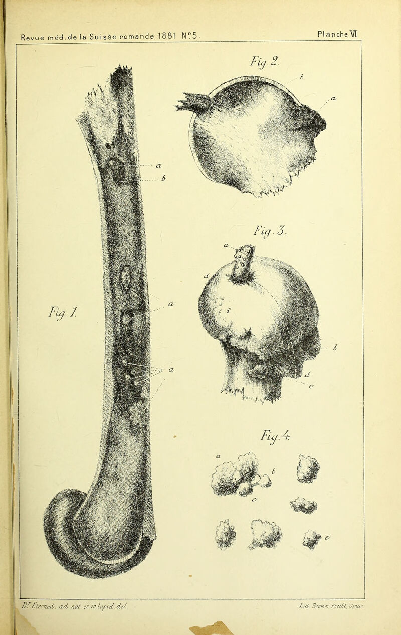 Dr£tcrnod, ad naC. et in lœpid cL>J. Jiri> Brt/rnm-KnecJit Gênent- Revue méd.de la Suisse romande 1881 N°5 Flcj . 3. Planche^/! Fy2.