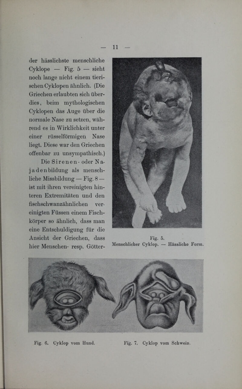 der hässlichste menschliche Cyklope — Fig. 5 — sieht noch lange nicht einem tieri- schen Cyklopen ähnlich. (Die Griechen erlaubten sich über- dies , beim mythologischen Cyklopen das Auge über die normale Nase zu setzen, wäh- rend es in Wirklichkeit unter einer rüsselförmigen Nase liegt. Diese war den Griechen offenbar zu unsympathisch.) Die Sirenen- oder N a- jadenbildung als mensch- liche Missbildung — Fig. 8 — ist mit ihren vereinigten hin- teren Extremitäten und den fischschwanzähnlichen ver- einigten Füssen einem Fisch- körper so ähnlich, dass man eine Entschuldigung für die