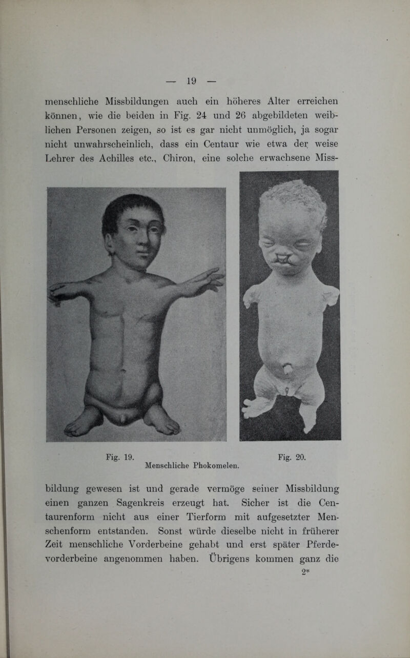menschliche Missbildungen auch ein höheres Alter erreichen können, wie die beiden in Fig. 24 und 26 abgebildeten weib- lichen Personen zeigen, so ist es gar nicht unmöglich, ja sogar nicht unwahrscheinlich, dass ein Centaur wie etwa der weise Lehrer des Achilles etc., Chiron, eine solche erwachsene Miss- Fig. 19. Fig. 20. Menschliche Phokomelen. bildung gewesen ist und gerade vermöge seiner Missbildung einen ganzen Sagenkreis erzeugt hat. Sicher ist die Cen- taurenform nicht aus einer Tierform mit aufgesetzter Men- schenform entstanden. Sonst würde dieselbe nicht in früherer Zeit menschliche Vorderbeine gehabt und erst später Pferde- vorderbeine angenommen haben. Übrigens kommen ganz die 2*
