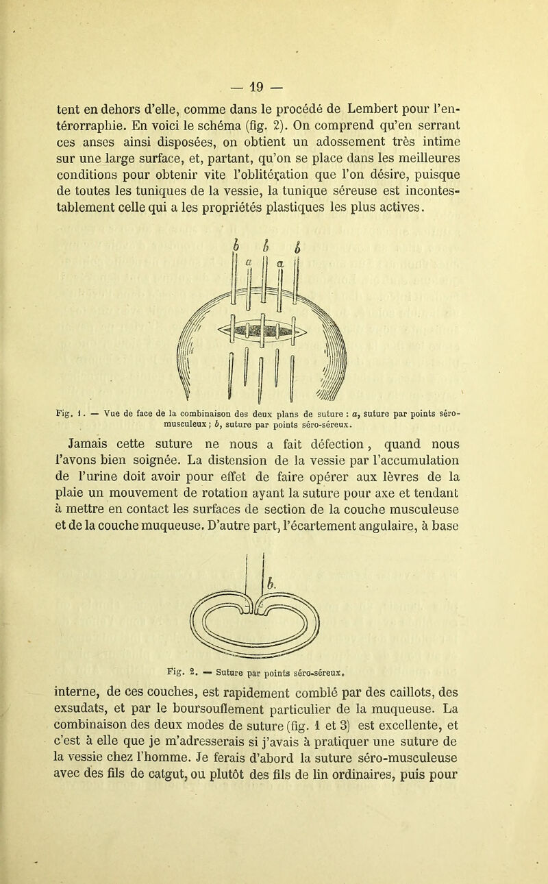 tent en dehors d’elle, comme dans le procédé de Lembert pour l’en- térorraphie. En voici le schéma (fig. 2). On comprend qu’en serrant ces anses ainsi disposées, on obtient un adossement très intime sur une large surface, et, partant, qu’on se place dans les meilleures conditions pour obtenir vite l’oblitération que l’on désire, puisque de toutes les tuniques de la vessie, la tunique séreuse est incontes- tablement celle qui a les propriétés plastiques les plus actives. Fig. 1. — Vue de face de la combinaison des deux plans de suture : a, suture par points séro- musculeux ; b, suture par points séro-séreux. Jamais cette suture ne nous a fait défection, quand nous l’avons bien soignée. La distension de la vessie par l’accumulation de l’urine doit avoir pour effet de faire opérer aux lèvres de la plaie un mouvement de rotation ayant la suture pour axe et tendant à mettre en contact les surfaces de section de la couche musculeuse et de la couche muqueuse. D’autre part, l’écartement angulaire, à base Fig. 2. Suture par points séro-séreux. interne, de ces couches, est rapidement comblé par des caillots, des exsudais, et par le boursouflement particulier de la muqueuse. La combinaison des deux modes de suture (fig. 1 et 3) est excellente, et c’est à elle que je m’adresserais si j’avais à pratiquer une suture de la vessie chez l’homme. Je ferais d’abord la suture séro-musculeuse avec des fils de catgut, ou plutôt des fils de lin ordinaires, puis pour