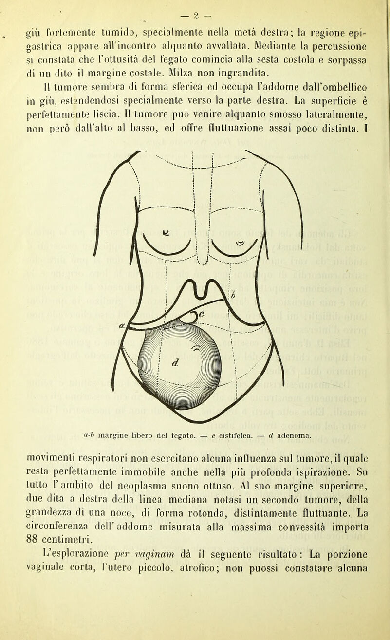 giù fortemente tumido, specialmente nella metà destra; la regione epi- gastrica appare all’incontro alquanto avvallata. Mediante la percussione si constata che l’ottusità del fegato comincia alla sesta costola e sorpassa di un dito il margine costale. Milza non ingrandita. 11 tumore sembra di forma sferica ed occupa l’addome daH’ombellico in giù, estendendosi specialmente verso la parte destra. La superficie è perfettamente liscia. Il tumore può venire alquanto smosso lateralmente, non però dall’alto al basso, ed offre fluttuazione assai poco distinta. I a-h margine libero del fegato. — c cistifelea. — d adenoma. movimenti respiratori non esercitano alcuna influenza sul tumore, il quale resta perfettamente immobile anche nella più profonda ispirazione. Su tutto l’ambito del neoplasma suono ottuso. Al suo margine superiore, due dita a destra della linea mediana notasi un secondo tumore, delta grandezza di una noce, di forma rotonda, distintamente fluttuante. La circonferenza dell’addome misurata alla massima convessità imporla 88 centimetri. L’esplorazione <pcr vaginam dà il seguente risultato : La porzione vaginale corta, l’utero piccolo, atrofico; non puossi constatare alcuna