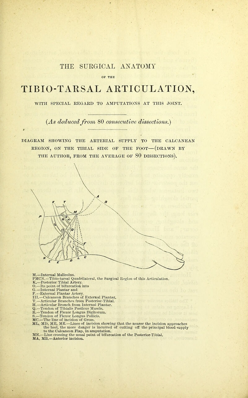 THE SURGICAL ANATOMY OF THE TIB I OTAR SAL ARTICULATION, WITH SPECIAL REGARD TO AMPUTATIONS AT THIS JOINT. (As deduced from, 80 co7isecutive dissections.) DIAGRAM SHOWING THE ARTERIAL SUPPLY TO THE CALCANEAN REGION, ON THE TIBIAL SIDE OF THE FOOT—(DRAWN BY THE AUTHOR, FROM THE AVERAGE OF 80 DISSECTIONS). M.—Internal Malleolus. PMCN.—Tibio-tarsal Quadrilateral, the Surgical Region of this Articulation. K.—Posterior Tibial Artery. O.—Its point of bifurcation into G. —Internal Plantar and F.—External Plantar Artery. III.—Calcanean Branches of External Plantar. T.—Articular Branches from Posterior-Tibial. H. —Articular Branch from Internal Plantar. Q.—Tendon of Tibialis Posticus Muscle. It.—Tendon of Flexor Longus Digitorum. S.—Tendon of Flexor Longus Pollicis. MC.—The line of incision of Gross. ML, MD, ME, ME.—Lines of incision showing that the nearer the incision approaches the heel, the more danger is incurred of cutting off the principal blood-supply to the Calcanean Flap, in amputation. MN.—Line crossing the usual point of bifurcation of the Posterior-Tibial. MA, MB.—Anterior incision.
