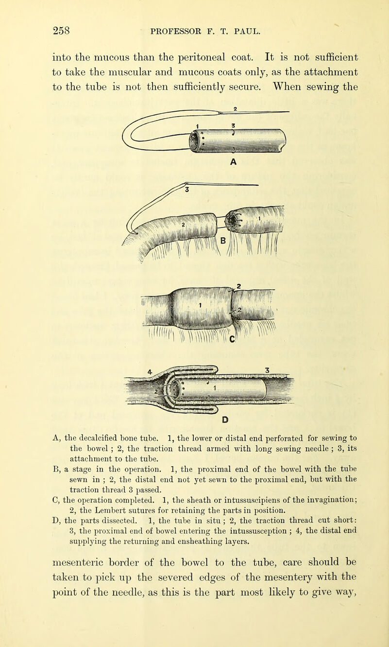 into the mucous than the peritoneal coat. It is not sufficient to take the muscular and mucous coats only, as the attachment to the tube is not then sufficiently secure. When sewing the A A, the decalcified bone tube. 1, the lower or distal end perforated for sewing to the bowel ; 2, the traction thread armed with long sewing needle ; 3, its attachment to the tube. B, a stage in the operation. 1, the proximal end of the bowel with the tube sewn in ; 2, the distal end not yet sewn to the proximal end, but with the traction thread 3 passed. C, the operation completed. 1, the sheath or intussuscipiens of the invagination; 2, the Lembert sutures for retaining the parts in position. D, the parts dissected. 1, the tube in situ; 2, the traction thread cut short: 3, the proximal end of bowel entering the intussusception ; 4, the distal end supplying the returning and ensheathing layers. mesenteric border of the bowel to the tube, care should be taken to pick up the severed edges of the mesentery with the point of the needle, as this is the part most likely to give way,