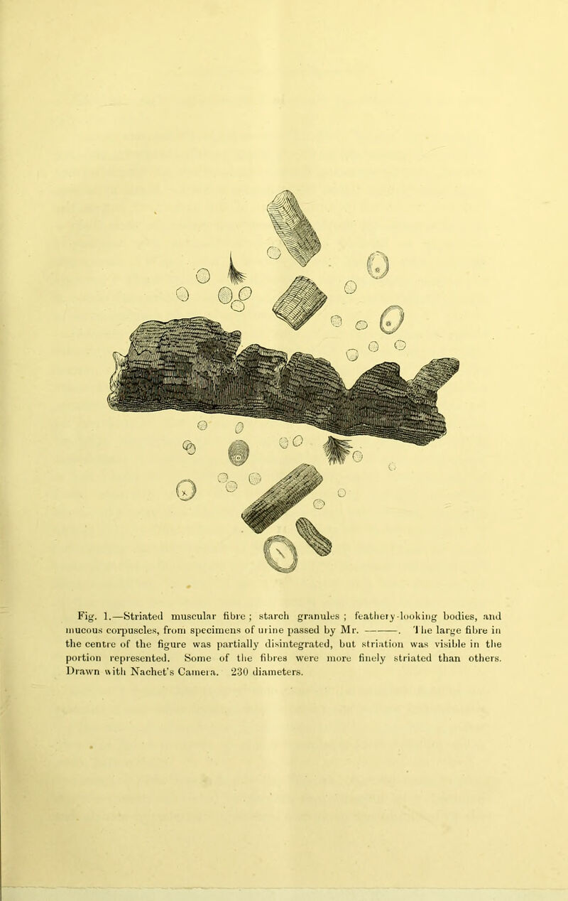 Fig. 1.—Striated muscular fibre ; starch granules ; feathery-looking bodies, and mucous corpuscles, from specimens of mine passed by Mr. . '1 lie large fibre in the centre of the figure was partially disintegrated, but striation was visible in the portion represented. Some of the fibres were more finely striated than others. Drawn with Nachet’s Camera. 230 diameters.