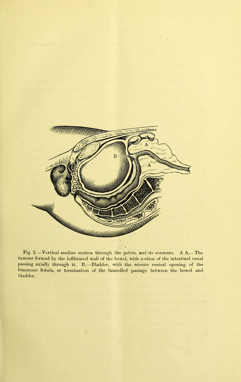 Fig. 2.—Vertical median section througli the pelvis, and its contents. A A.—The tumour formed by the infiltrated wall of the bowel, with stction of the intestinal canal passing axially through it. B.—Bladder, with the minute vesical opening of the bimucous fistula, or termination of the funnelled passage between the bowel and bladder.