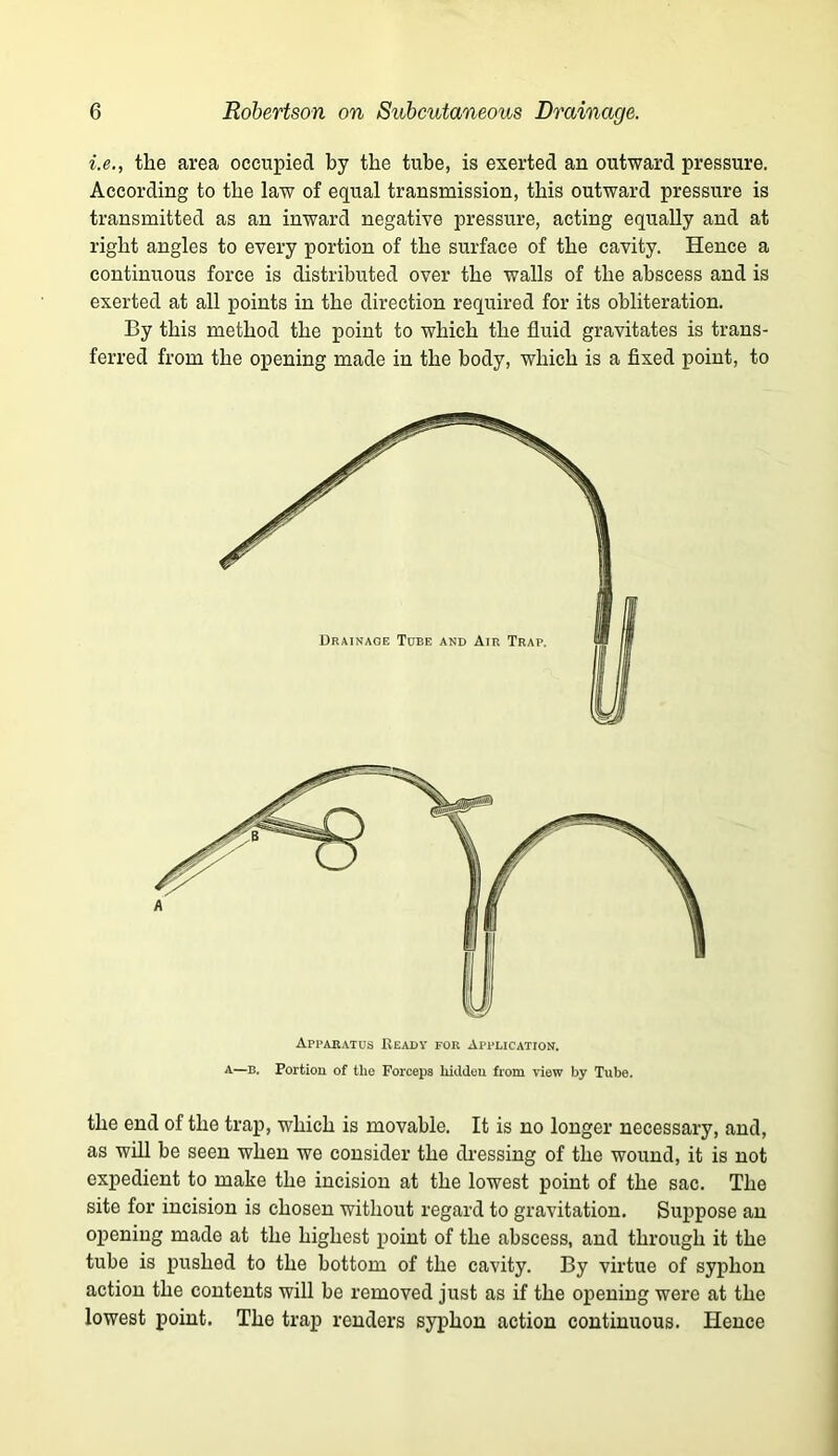i.e., the area occupied by the tube, is exerted an outward pressure. According to the law of equal transmission, this outward pressure is transmitted as an inward negative pressure, acting equally and at right angles to every portion of the surface of the cavity. Hence a continuous force is distributed over the walls of the abscess and is exerted at all points in the direction required for its obliteration. By this method the point to which the fluid gravitates is trans- ferred from the opening made in the body, which is a fixed point, to Drainage Tube and Am Trap. Apparatus Readt for Application. —B. Portion of the Forceps hiddcu from view by Tube. the end of the trap, which is movable. It is no longer necessary, and, as will be seen when we consider the dressing of the wound, it is not expedient to make the incision at the lowest point of the sac. The site for incision is chosen without regard to gravitation. Suppose an opening made at the highest point of the abscess, and through it the tube is pushed to the bottom of the cavity. By virtue of syphon action the contents will be removed just as if the opening were at the lowest point. The trap renders syphon action continuous. Hence