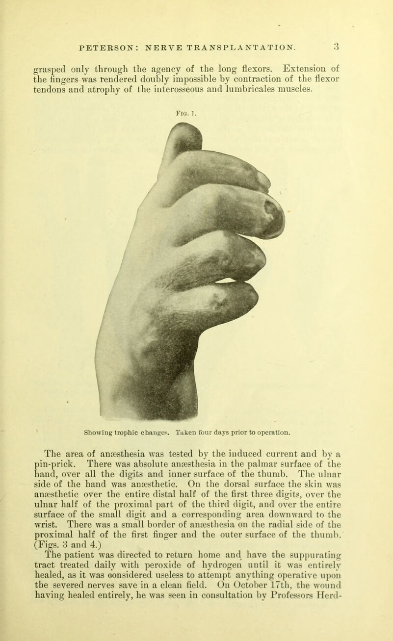 grasped only through the agency of the long flexors. Extension of the fingers was rendered doubly impossible by contraction of the flexor tendons and atrophy of the interosseous and lumbricales muscles. Fig. 1. Showing trophic change^. Taken four days prior to operation. The area of anajsthesia was tested by the induced current and by a pin-prick. There was absolute amesthesia in the palmar surface of the hand, over all the digits and inner surface of the thuiub. The ulnar side of the hand was ana>sthetic. On the dorsal surface the skin was an?e.sthetic over the entire distal half of the first three digits, over the ulnar half of the proximal part of the third digit, and over the entire surface of the small digit and a corresponding area downward to the wrist. There was a small border of anajsthesia on the radial side of the proximal half of the first finger and the outer surface of the thumb. (Fig.s. 3 and 4.) The patient was directed to return home and have the suppurating tract treated daily with peroxide of hydrogen until it was entirely healed, as it was oonsidered useless to attempt anything operative ujion the severed nerves save in a clean field. On October 17th, the wound having healed entirely, he was seen in consultation by Professors Herd-