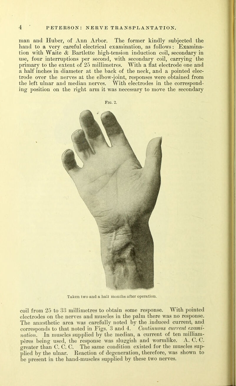 man and Huber, of Ann Arbor. The former kindly subjected the hand to a very careful electrical examination, as follows: Examina- tion with Waite & Bartlette high-tension induction coil, secondary in use, four interruptions per second, with secondary coil, carrying the primary to the extent of 25 millimetres. With a flat electrode one and a half inches in diameter at the back of the neck, and a pointed elec- trode over the nerves at the elbow-joint, responses were obtained from the left ulnar and median nerves. With electrodes in the correspond- ing position on the right arm it was necessary to move the secondary Fig. 2. Taken two and a hall months after operation. coil from 25 to 38 millimetres to obtain some response. With pointed electrodes on the nerves and muscles iu the palm there was no response. The antesthetic area was carefully noted by the induced current, and corresponds to that noted in Figs. 3 and 4. Continuous current exami- nation. In muscles supplied by the median, a current of ten milliam- peres being used, the response was shurgish and wormlike. A. C. C. greater than C. C. C. The same condition existed for the muscles sup- plied by the ulnar. Reaction of degeneration, therefore, was shown to be present in the hand-muscles supplied by these two nerves.