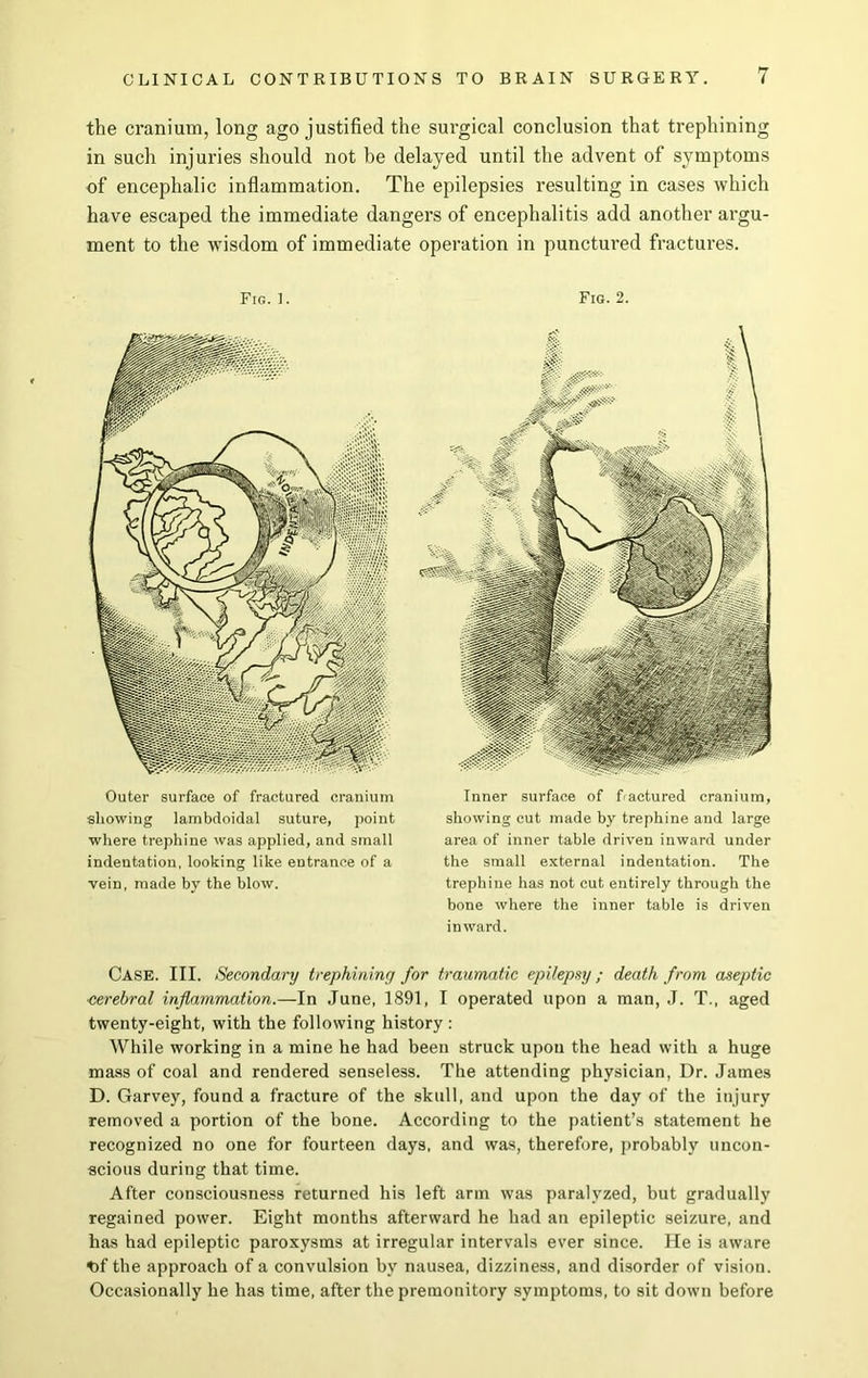 the cranium, long ago justified the surgical conclusion that trephining in such injuries should not he delayed until the advent of symptoms of encephalic inflammation. The epilepsies resulting in cases which have escaped the immediate dangers of encephalitis add another argu- ment to the wisdom of immediate operation in punctured fractures. Fig. 1. Outer surface of fractured cranium showing lambdoidal suture, point where trephine was applied, and small indentation, looking like entrance of a vein, made by the blow. Fig. 2. Inner surface of factored cranium, showing cut made by trephine and large area of inner table driven inward under the small external indentation. The trephine has not cut entirely through the bone where the inner table is driven inward. Case. III. Secondary trephining for traumatic epilepsy; death from aseptic ■cerebral inflammation.—In June, 1891, I operated upon a man, J. T., aged twenty-eight, with the following history : While working in a mine he had been struck upon the head with a huge mass of coal and rendered senseless. The attending physician, Dr. James D. Garvey, found a fracture of the skull, and upon the day of the injury removed a portion of the bone. According to the patient’s statement he recognized no one for fourteen days, and was, therefore, probably uncon- scious during that time. After consciousness returned his left arm was paralyzed, but gradually regained power. Eight months afterward he had an epileptic seizure, and has had epileptic paroxysms at irregular intervals ever since. He is aware t)f the approach of a convulsion by nausea, dizziness, and disorder of vision. Occasionally he has time, after the premonitory symptoms, to sit down before