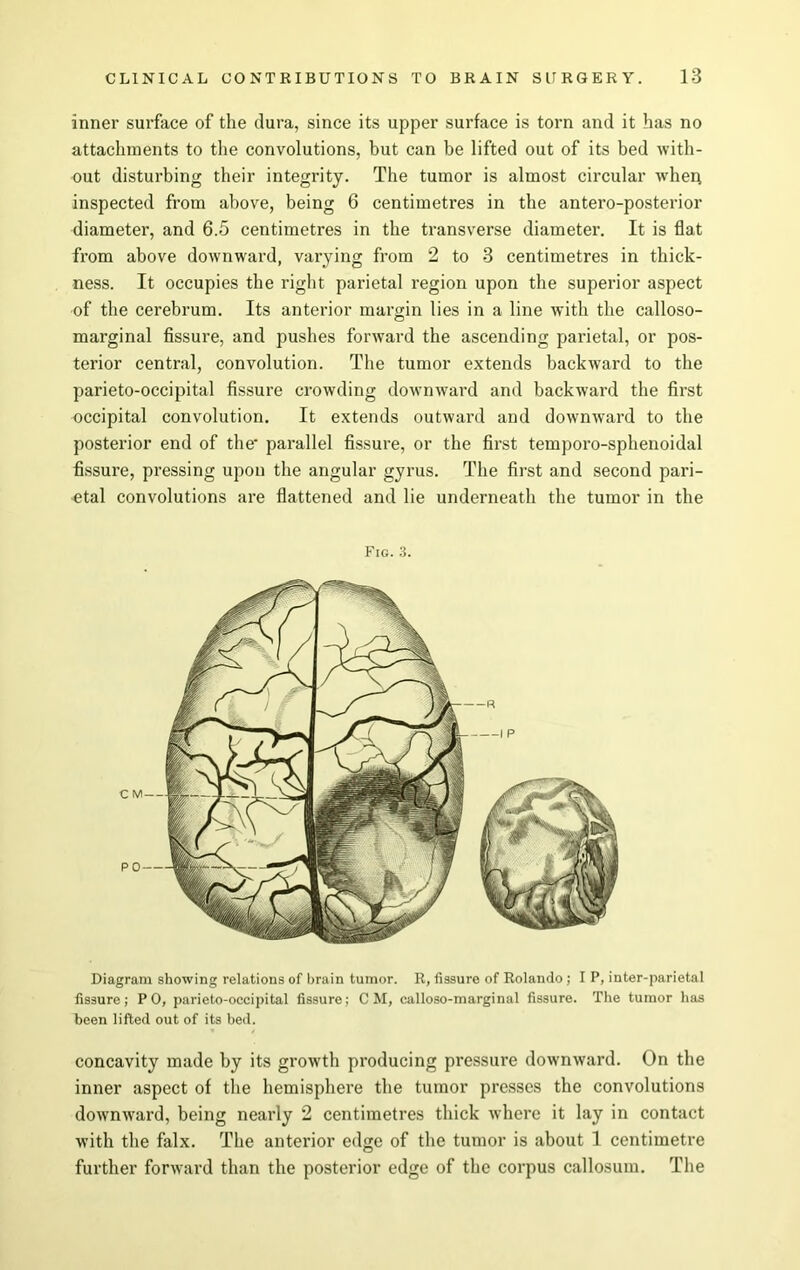 inner surface of the dura, since its upper surface is torn and it has no attachments to the convolutions, but can be lifted out of its bed with- out disturbing their integrity. The tumor is almost circular wher; inspected from above, being 6 centimetres in the antero-posterior diameter, and 6.5 centimetres in the transverse diameter. It is flat from above downward, varying from 2 to 3 centimetres in thick- ness. It occupies the right parietal region upon the superior aspect of the cerebrum. Its anterior margin lies in a line with the calloso- marginal fissure, and pushes forward the ascending parietal, or pos- terior central, convolution. The tumor extends backward to the parieto-occipital fissure crowding downward and backward the first occipital convolution. It extends outward and downward to the posterior end of the' parallel fissure, or the first temporo-sphenoidal fissure, pressing upon the angular gyrus. The first and second pari- etal convolutions are flattened and lie underneath the tumor in the Fig. 3. Diagram showing relations of brain tumor. R, fissure of Rolando ; I P, inter-parietal fissure; P 0, parieto-occipital fissure; CM, calloso-marginal fissure. The tumor has been lifted out of its bed. concavity made by its growth producing pressure downward. On the inner aspect of the hemisphere the tumor presses the convolutions downward, being nearly 2 centimetres thick where it lay in contact with the falx. The anterior edge of the tumor is about 1 centimetre further forward than the posterior edge of the corpus callosum. The