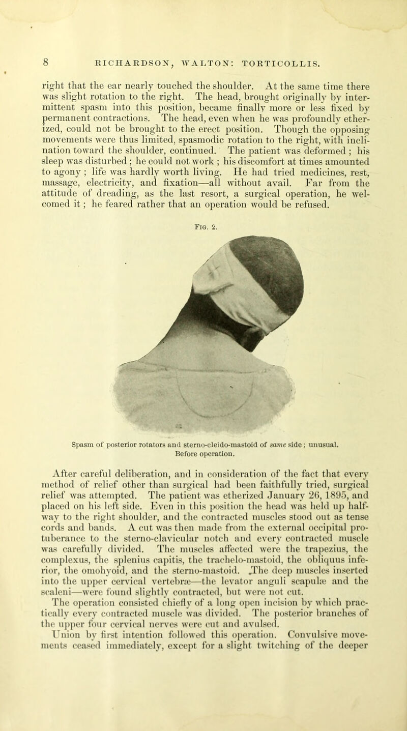 right that the ear nearly touched the shoulder. At the same time there was slight rotation to the right. The head, brought originally by inter- mittent spasm into this position, became finally more or less fixed by permanent contractions. The head, even when he was profoundly ether- ized, could not be brought to the erect position. Though the opposing movements were thus limited, spasmodic rotation to the right, with incli- nation toward the shoulder, continued. The patient was deformed ; his sleep was disturbed ; he could not work ; his discomfort at times amounted to agony ; life was hardly worth living. He had tried medicines, rest, massage, electricity, and fixation—all without avail. Far from the attitude of dreading, as the last resort, a surgical operation, he wel- comed it; he feared rather that an operation would be refused. Fig. 2. Spasm of posterior rotators and sterno-cleido-mastoid of same side; unusual. Before operation. After careful deliberation, and in consideration of the fact that every method of relief other than surgical had been faithfully tried, surgical relief was attempted. The patient was etherized January 2(1, 1895, and placed on his left side. Even in this position the head was held up half- way to the right shoulder, and the contracted muscles stood out as tense cords and bands. A cut was then made from the external occipital pro- tuberance to the sterno-elavicular notch and every contracted muscle was carefully divided. The muscles affected were the trapezius, the complexus, the splenius capitis, the traehelo-mastoid, the obliquus infe- rior, the omohyoid, and the sterno-mastoid. .The deep muscles inserted into the upper cervical vertebne—the levator anguli scapulae and the scaleni—were found slightly contracted, but were not cut. The operation consisted chiefly of a long open incision by which prac- tically every contracted muscle was divided. The posterior branches of the upper four cervical nerves were cut and avulsed. Union by first intention followed this operation. Convulsive move- ments ceased immediately, except for a slight twitching of the deeper