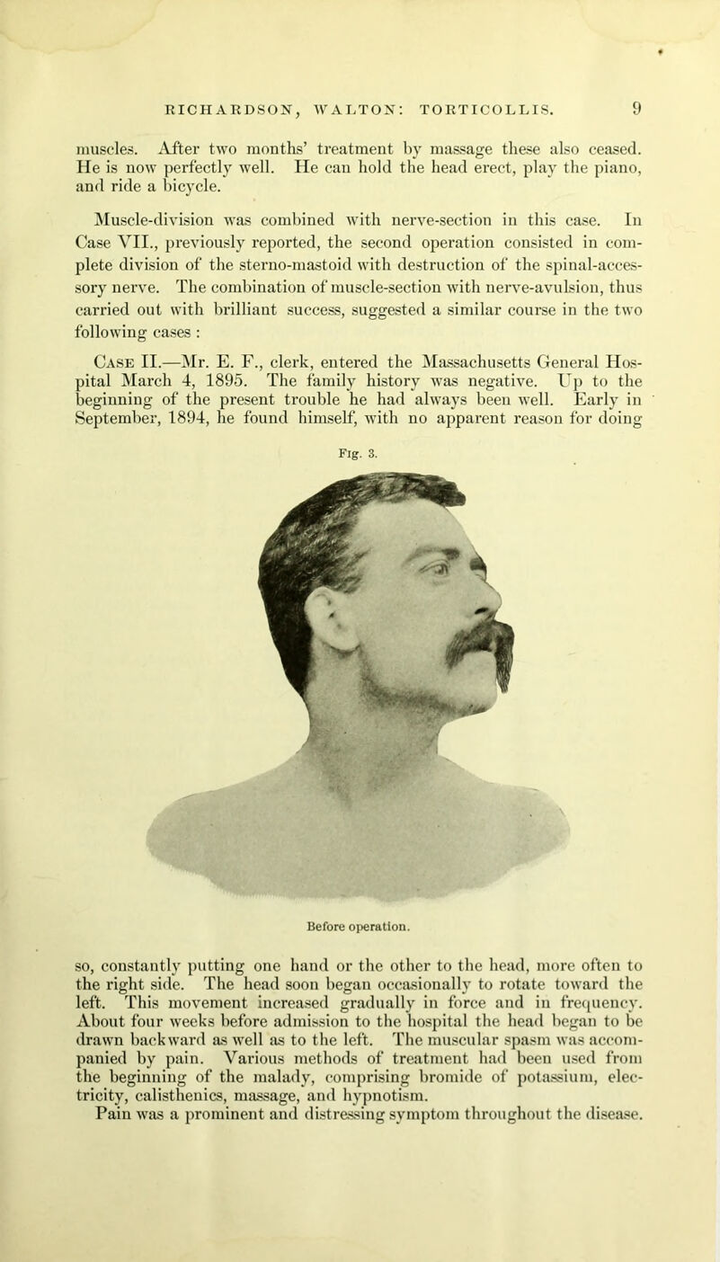 muscles. After two months’ treatment by massage these also ceased. He is now perfectly well. He can hold the head erect, play the piano, and ride a bicycle. Muscle-division was combined with nerve-section in this case. In Case VII., previously reported, the second operation consisted in com- plete division of the sterno-mastoid with destruction of the spinal-acces- sory nerve. The combination of muscle-section with nerve-avulsion, thus carried out with brilliant success, suggested a similar course in the two following cases : Case II.—Mr. E. F., clerk, entered the Massachusetts General Hos- pital March 4, 1895. The family history was negative. Up to the beginning of the present trouble he had always been well. Early in September, 1894, he found himself, with no apparent reason for doing Fig. 3. Before operation. so, constantly putting one hand or the other to the head, more often to the right side. The head soon began occasionally to rotate toward the left. This movement increased gradually in force and in frequency. About four weeks before admission to the hospital the head began to be drawn backward as well as to the left. The muscular spasm was accom- panied by pain. Various methods of treatment had been used from the beginning of the malady, comprising bromide of potassium, elec- tricity, calisthenics, massage, and hypnotism. Pain was a prominent and distressing symptom throughout the disease.