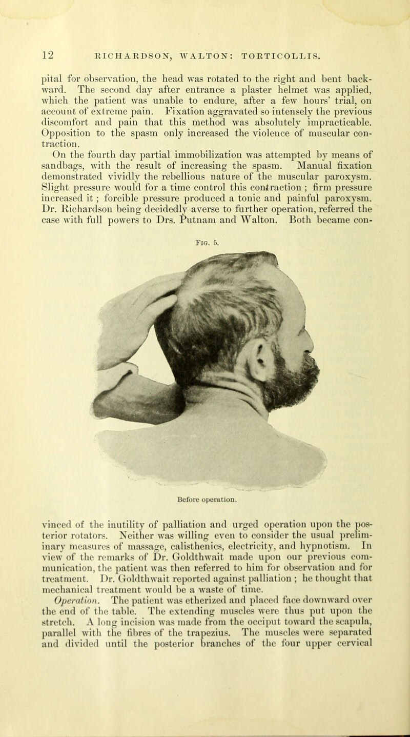 pital for observation, the head was rotated to the right and bent back- ward. The second day after entrance a plaster helmet was applied, which the patient was unable to endure, after a few hours’ trial, on account of extreme pain. Fixation aggravated so intensely the previous discomfort and pain that this method was absolutely impracticable. Opposition to the spasm only increased the violence of muscular con- traction. On the fourth day partial immobilization was attempted by means of sandbags, with the result of increasing the spasm. Manual fixation demonstrated vividly the rebellious nature of the muscular paroxysm. Slight pressure would for a time control this contraction ; firm pressure increased it; forcible pressure produced a tonic and painful paroxysm. Dr. Richardson being decidedly averse to further operation, referred the case with full powers to Drs. Putnam and Walton. Both became con- FlG. 5. Before operation. vinced of the inutility of palliation and urged operation upon the pos- terior rotators. Neither was willing even to consider the usual prelim- inary measures of massage, calisthenics, electricity, and hypnotism. In view of the remarks of Dr. Goldthwait made upon our previous com- munication, the patient was then referred to him for observation and for treatment. Dr. Goldthwait reported against palliation ; he thought that mechanical treatment would be a waste of time. Operation. The patient was etherized and placed face downward over the end of the table. The extending muscles were thus put upon the stretch. A long incision was made from the occiput toward the scapula, parallel with the fibres of the trapezius. The muscles were separated and divided until the posterior branches of the four upper cervical