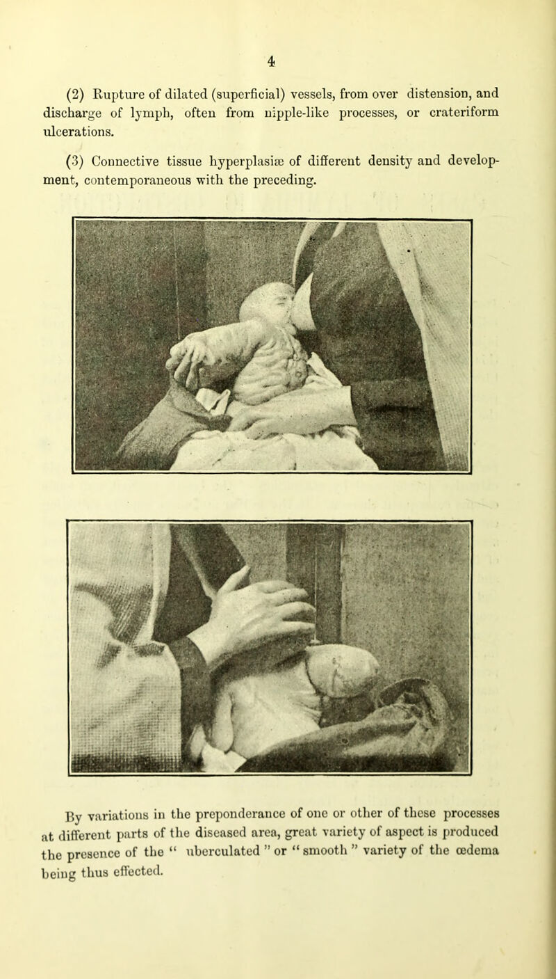 (2) Rupture of dilated (superficial) vessels, from over distension, and discharge of lymph, often from nipple-like processes, or crateriform ulcerations. (3) Connective tissue hyperplasia; of different density and develop- ment, contemporaneous with the preceding. By variations in the preponderance of one or other of these processes at different parts of the diseased area, great variety of aspect is produced the presence of the “ uberculated ” or “ smooth ” variety of the oedema being thus effected.