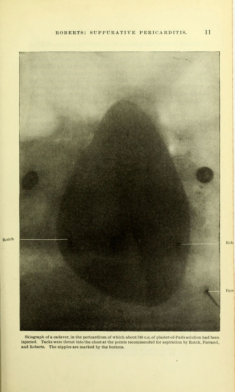 Skiagraph of a cadaver, in the pericardium of which about 740 c.c. of plaster-of-Parissolution had been injected. Tacks were thrust into the chest at the points recommended for aspiration by Rotcb, Ferrand, and Roberts. The nipples are marked by the buttons.