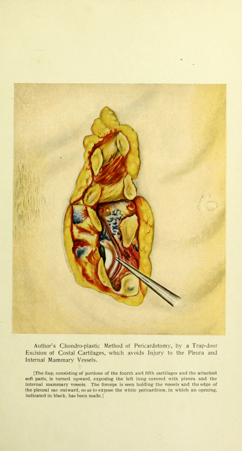 Author’s Chondro-plastic Method of Pericardotomv, by a Trap-door Excision of Costal Cartilages, which avoids Injury to the Pleura and Internal Mammary Vessels. [The flap, consisting of portions of the fourth and fifth cartilages and the attached soft parts, is turned upward, exposing the left lung covered with pleura and the internal mammary vessels. The forceps is seen holding the vessels and the edge of the pleural sac outward, so as to expose the white pericardium, in which an opening, indicated in black, has been made.]