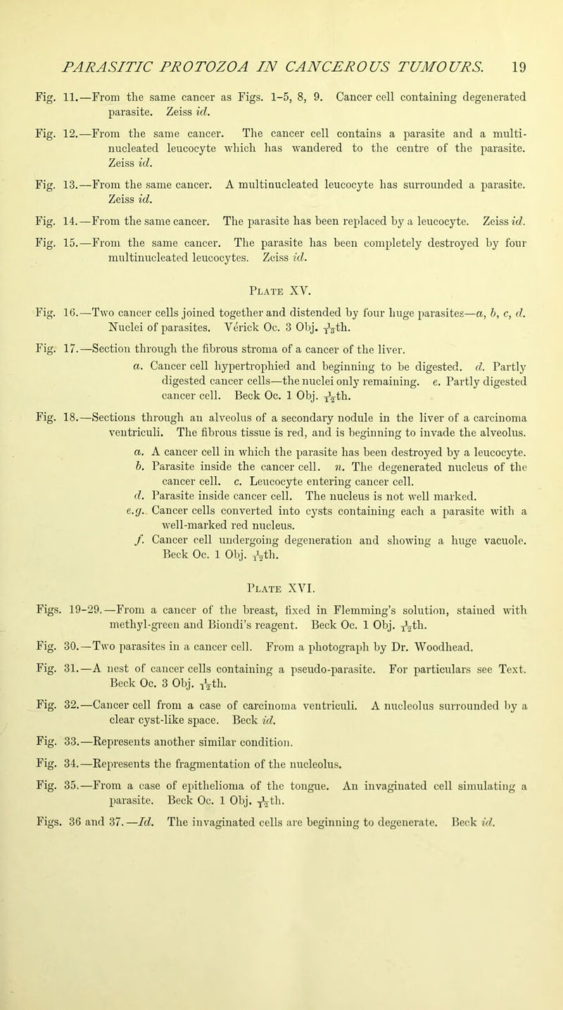 Fig. 11.—From the same cancer as Figs. 1-5, 8, 9. Cancer cell containing degenerated parasite. Zeiss id. Fig. 12.—From the same cancer. The cancer cell contains a parasite and a multi- nucleated leucocyte which has wandered to the centre of the parasite. Zeiss id. Fig. 13.—From the same cancer. A multi nucleated leucocyte has surrounded a parasite. Zeiss id. Fig. 14.—From the same cancer. The parasite has been replaced by a leucocyte. Zeiss id. Fig. 15.—From the same cancer. The parasite has been completely destroyed by four multinucleated leucocytes. Zeiss id. Plate XV. Fig. 16.—Two cancer cells joined together and distended by four huge parasites—a, b, c, d. Nuclei of parasites. Verick Oc. 3 Obj. Tyth. Fig. 17.—Section through the fibrous stroma of a cancer of the liver. a. Cancer cell hypertrophied and beginning to be digested, d. Partly digested cancer cells—the nuclei only remaining, e. Partly digested cancer cell. Beck Oc. 1 Obj. ^th. Fig. 18.—Sections through an alveolus of a secondary nodule in the liver of a carcinoma veutriculi. The fibrous tissue is red, and is beginning to invade the alveolus. a. A cancer cell in which the parasite has been destroyed by a leucocyte. b. Parasite inside the cancer cell. n. The degenerated nucleus of the cancer cell. c. Leucocyte entering cancer cell. d. Parasite inside cancer cell. The nucleus is not well marked. e.y. Cancer cells converted into cysts containing each a parasite with a well-marked red nucleus. /. Cancer cell undergoing degeneration and showing a huge vacuole. Beck Oc. 1 Obj. -^th. Plate XYI. Figs. 19-29.—From a cancer of the breast, fixed in Flemming’s solution, stained with methyl-green and Biondi’s reagent. Beck Oc. 1 Obj. ^th. Fig. 30.—Two parasites in a cancer cell. From a photograph by Dr. Woodhead. Fig. 31.—A nest of cancer cells containing a pseudo-parasite. For particulars see Text. Beck Oc. 3 Obj. 115-th. Fig. 32.—Cancer cell from a case of carcinoma veutriculi. A nucleolus surrounded by a clear cyst-like space. Beck id. Fig. 33.—Represents another similar condition. Fig. 34.—Represents the fragmentation of the nucleolus. Fig. 35.—From a case of epithelioma of the tongue. An invaginated cell simulating a parasite. Beck Oc. 1 Obj. TVth. Figs. 36 and 37.—Id. The invaginated cells are beginning to degenerate. Beck id.