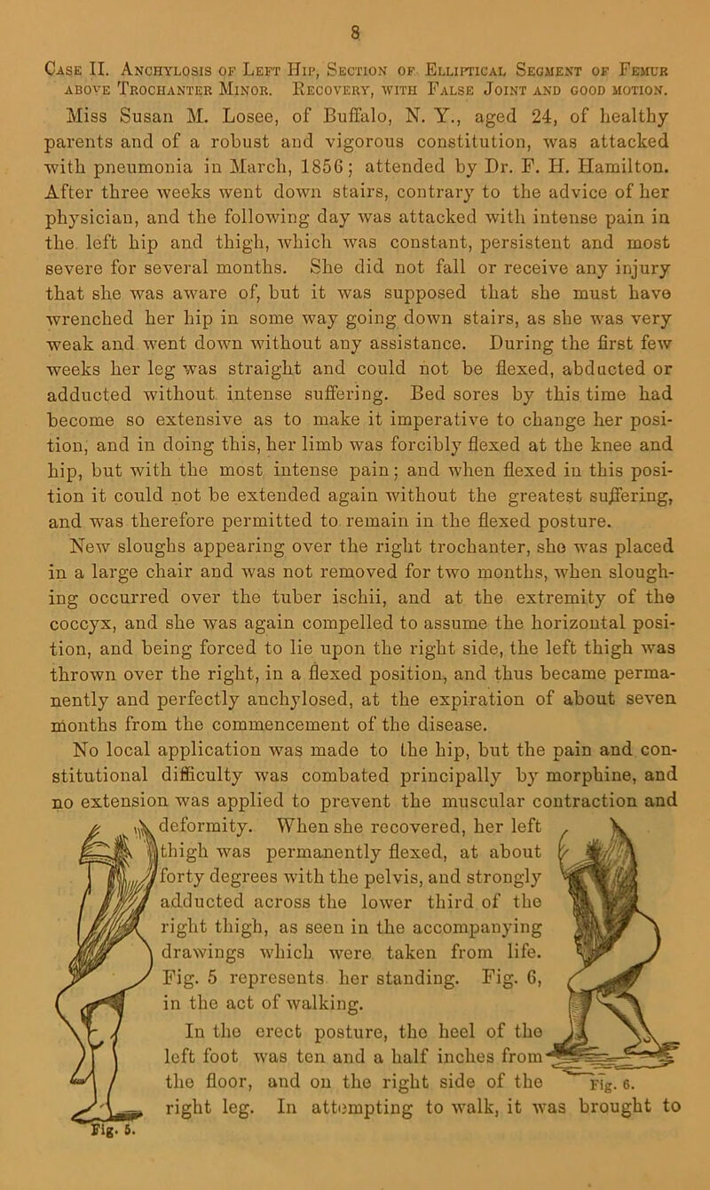 Case II. Anchylosis of Left Hip, Section of Elliptical Segment of Femur ABOVE Trochanter Minor. Recovery, with False Joint and good motion. Miss Susan M. Losee, of Buffalo, N. Y., aged 24, of healthy parents and of a robust and vigorous constitution, was attacked with pneumonia in March, 1856; attended by Dr, F. H. Hamilton. After three weeks went down stairs, contrary to the advice of her physician, and the following day was attacked with intense pain in the, left hip and thigh, which was constant, persistent and most severe for several months. She did not fall or receive any injury that she was aware of, but it was supposed that she must have wrenched her hip in some way going down stairs, as she was very weak and went down without any assistance. During the first few weeks her leg was straight and could not be flexed, abducted or adducted without, intense suffering. Bed sores by this time had become so extensive as to make it imperative to change her posi- tion, and in doing this, her limb was forcibly flexed at the knee and hip, but with the most intense pain; and when flexed in this posi- tion it could not be extended again without the greatest suflering, and was therefore permitted to remain in the flexed posture. New sloughs appearing over the right trochanter, she was placed in a large chair and was not removed for two months, when slough- ing occurred over the tuber ischii, and at the extremity of the coccyx, and she was again compelled to assume the horizontal posi- tion, and being forced to lie upon the right side, the left thigh was thrown over the right, in a flexed position, and thus became perma- nently and perfectly anchylosed, at the expiration of about seven months from the commencement of the disease. No local application was made to the hip, but the pain and con- stitutional difficulty was combated principally by morphine, and no extension was applied to prevent the muscular contraction and deformity. When she recovered, her left thigh was permanently flexed, at about fforty degrees with the pelvis, and strongly adducted across the lower third of the right thigh, as seen in the accompanying drawings which were taken from life. Fig. 5 represents her standing. Fig. 6, in the act of walking. In the erect posture, the heel of the left foot was ten and a half inches from the floor, and on the right side of the 6. right leg. In attempting to walk, it was brought to Fig. 6.