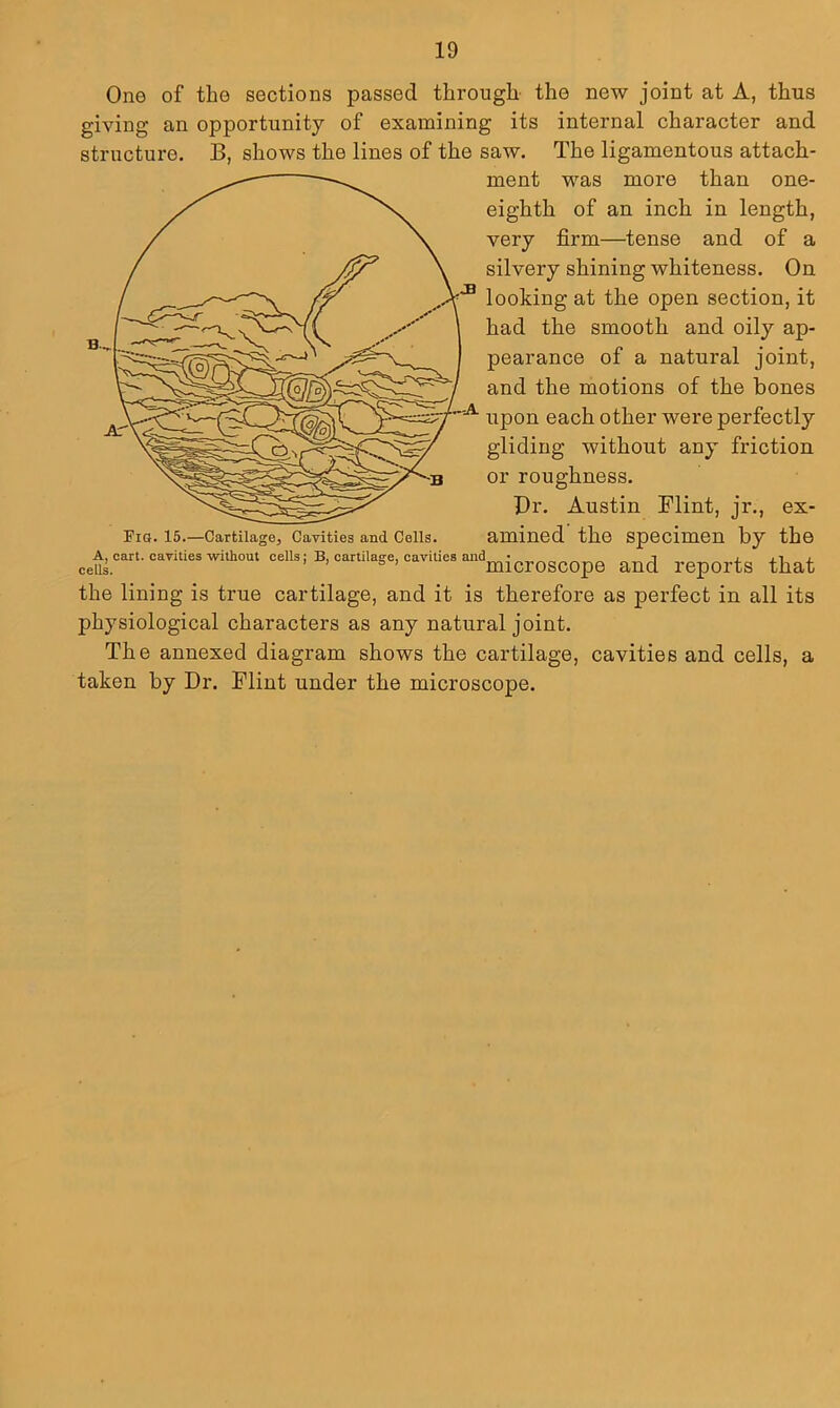 One of the sections passed through- the new joint at A, thus giving an opportunity of examining its internal character and structure. B, shows the lines of the saw. The ligamenteus attach- ment was more than one- eighth of an inch in length, very firm—tense and of a silvery shining whiteness. On looking at the open section, it had the smooth and oily ap- pearance of a natural joint, and the motions of the bones upon each other were perfectly gliding without any friction or roughness. Or. Austin Flint, jr., ex- Fig. 15.—Cartilage, Cavities and Cells. amined the Specimen by the c A, cart, cavities without cells; B, cartilage, cavities and repOrtS that the lining is true cartilage, and it is therefore as perfect in all its physiological characters as any natural joint. The annexed diagram shows the cartilage, cavities and cells, a taken by Dr. Flint under the microscope.