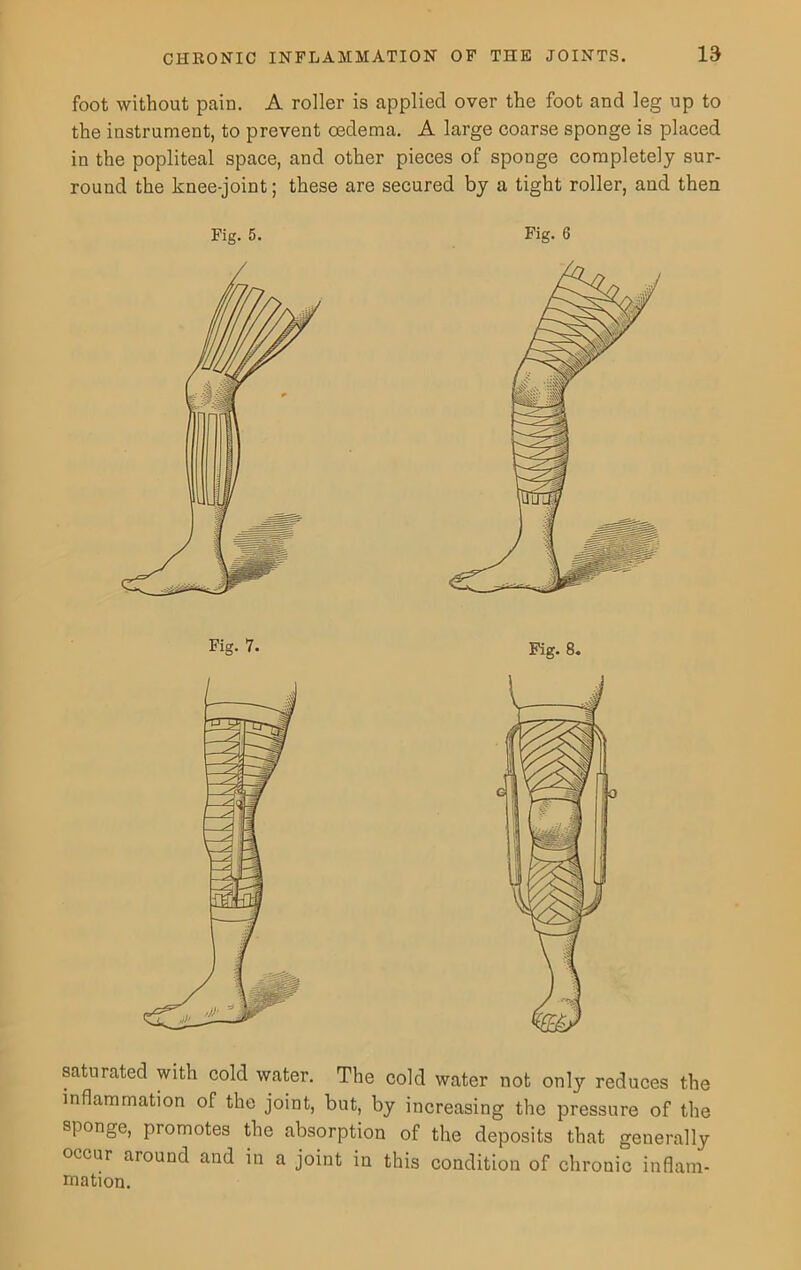 foot without pain. A roller is applied over the foot and leg up to the instrument, to prevent oedema. A large coarse sponge is placed in the popliteal space, and other pieces of sponge completely sur- round the knee-joint; these are secured by a tight roller, and then Fig. 5. Fig. 6 saturated with cold water. The cold water not only reduces the inflammation of the joint, but, by increasing the pressure of the sponge, promotes the absorption of the deposits that generally occur around and in a joint in this condition of chronic inflam- mation.