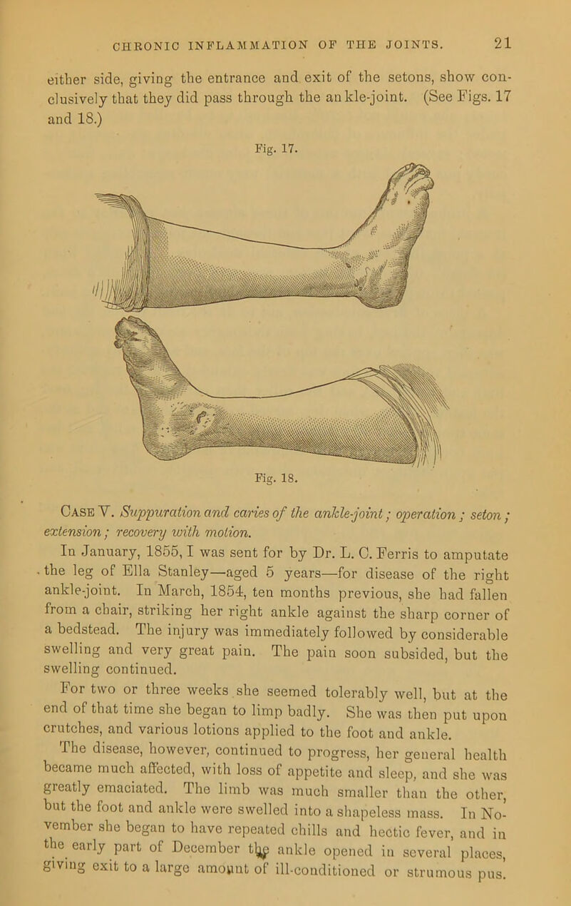 either side, giving the entrance and exit of the setons, show con- clusively that they did pass through the ankle-joint. (See Figs. 17 and 18.) Fig. 17. Case V. Suppuration and caries of the ankle-joint; operation ; seton ; extension ; recovery with motion. In January, 1855,1 was sent for by Dr. L. C. Ferris to amputate the leg of Ella Stanley—aged 5 years—for disease of the right ankle-joint. In March, 1854, ten months previous, she had fallen from a chair, striking her right ankle against the sharp corner of a bedstead. The injury was immediately followed by considerable swelling and very great pain. The pain soon subsided, but the swelling continued. For two or three weeks , she seemed tolerably well, but at the end of that time she began to limp badly. She was then put upon crutches, and various lotions applied to the foot and ankle. The disease, however, continued to progress, her general health became much affected, with loss of appetite and sleep, and she was greatly emaciated. The limb was much smaller than the other, but the foot and ankle were swelled into a shapeless mass. In No- vember she began to have repeated chills and hectic fever, and in the early pait of December tlj^; ankle opened in several places, Qiving exit to a large amount of ill-conditioned or strumous pus.