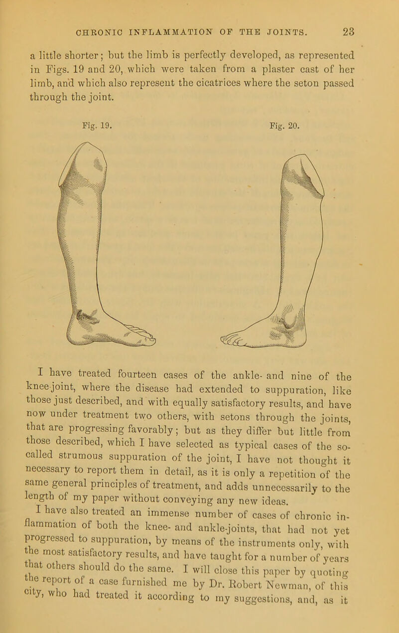a little shorter; but the limb is perfect^ developed, as represented in Figs. 19 and 20, which were taken from a plaster cast of her limb, and which also represent the cicatrices where the seton passed through the joint. Fig. 19. Fig. 20. I have treated fourteen cases of the ankle- and nine of the knee-joint, where the disease had extended to suppuration, like those just described, and with equally satisfactory results, and have now under treatment two others, with setons through the joints, that are progressing favorably; but as they differ but little from' those described, which I have selected as typical cases of the so- called strumous suppuration of the joint, I have not thought it necessary to report them in detail, as it is only a repetition of the same general principles of treatment, and adds unnecessarily to the length of my paper without conveying any new ideas. I have also treated an immense number of cases of chronic in- flammation of both the knee- and ankle-joints, that had not yet progressed to suppuration, by means of the instruments only, with the most satisfactory results, and have taught for a number of years at others should do the same. I will close this paper by quoting ..S rep.°rt °f a case finished me by Dr. Robert Newman, of this 1 7’ Wh° had treated it according to my suggestions, and, as it