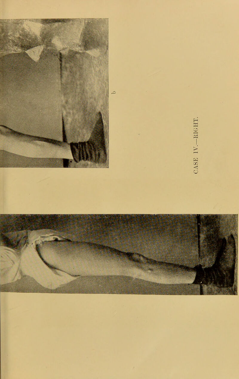 CASE IV.—1-ilGlIT.