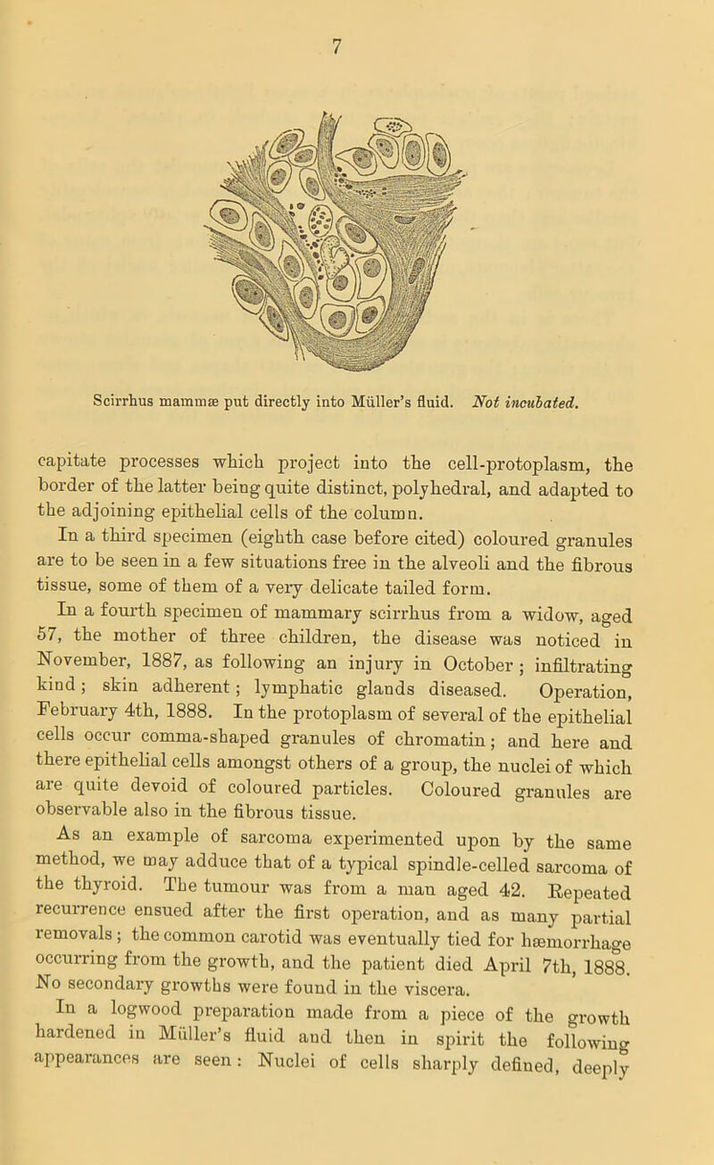 Scirrhus mammae put directly into Muller’s fluid. Not inculated. capitate processes which project into the cell-protoplasm, the border of the latter being quite distinct, polyhedral, and adapted to the adjoining epithelial cells of the column. In a third specimen (eighth case before cited) coloured granules are to be seen in a few situations free in the alveoli and the fibrous tissue, some of them of a very delicate tailed form. In a fourth specimen of mammary scirrhus from a widow, aged 57, the mother of three children, the disease was noticed in November, 1887, as following an injury in October ; infiltrating kind ; skin adherent; lymphatic glands diseased. Operation, February 4th, 1888. In the protoplasm of several of the epithelial cells occur comma-shaped granules of chromatin; and here and there epithelial cells amongst others of a group, the nuclei of which are quite devoid of coloured particles. Coloured granules are observable also in the fibrous tissue. As an example of sarcoma experimented upon by the same method, we may adduce that of a typical spindle-celled sarcoma of the thyroid. The tumour was from a man aged 42. Repeated recurrence ensued after the first operation, and as many partial removals; the common carotid was eventually tied for haemorrhage occurring from the growth, and the patient died April 7th, 1888. No secondary growths were found in the viscera. In a logwood preparation made from a piece of the growth hardened in Muller’s fluid aud then in spirit the following appearances are seen: Nuclei of cells sharply defined, deeply