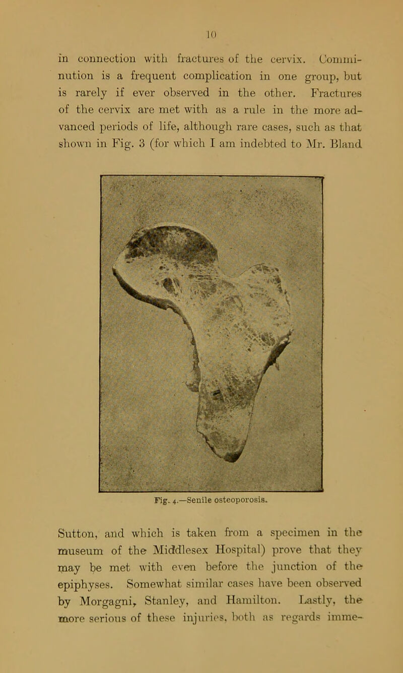 in connection witii fractures of tlie cervix. Commi- nution is a frequent complication in one group, but is rarely if ever observed in the other. Fractures of the cervix are met with as a rule in the more ad- vanced periods of life, although rare cases, such as that shown in Fig. 3 (for which I am indebted to IMr. Bland Fig. 4.—Senile osteoporosis. Sutton, and which is taken fi-om a specimen in the museum of the Middlesex Hospital) prove that they may be met with even before the junction of the epiphyses. Somewhat similar cases have been obseiwed by Morgagni, Stanley, and Hamilton. Lastly, the more serious of these injuries, botli as regards imme-